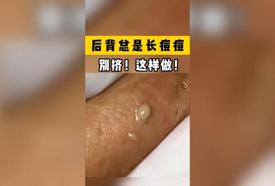 前胸后背总长痘，别挤了，试试这样处理