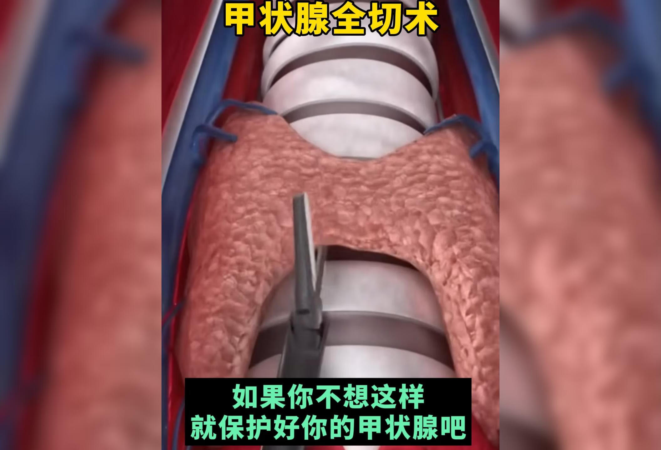 3D动画演示甲状腺全切术
