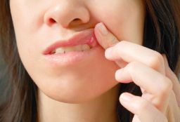 口腔溃疡治疗方案