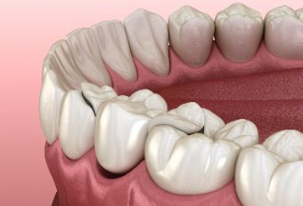 牙线会使牙缝变大吗？