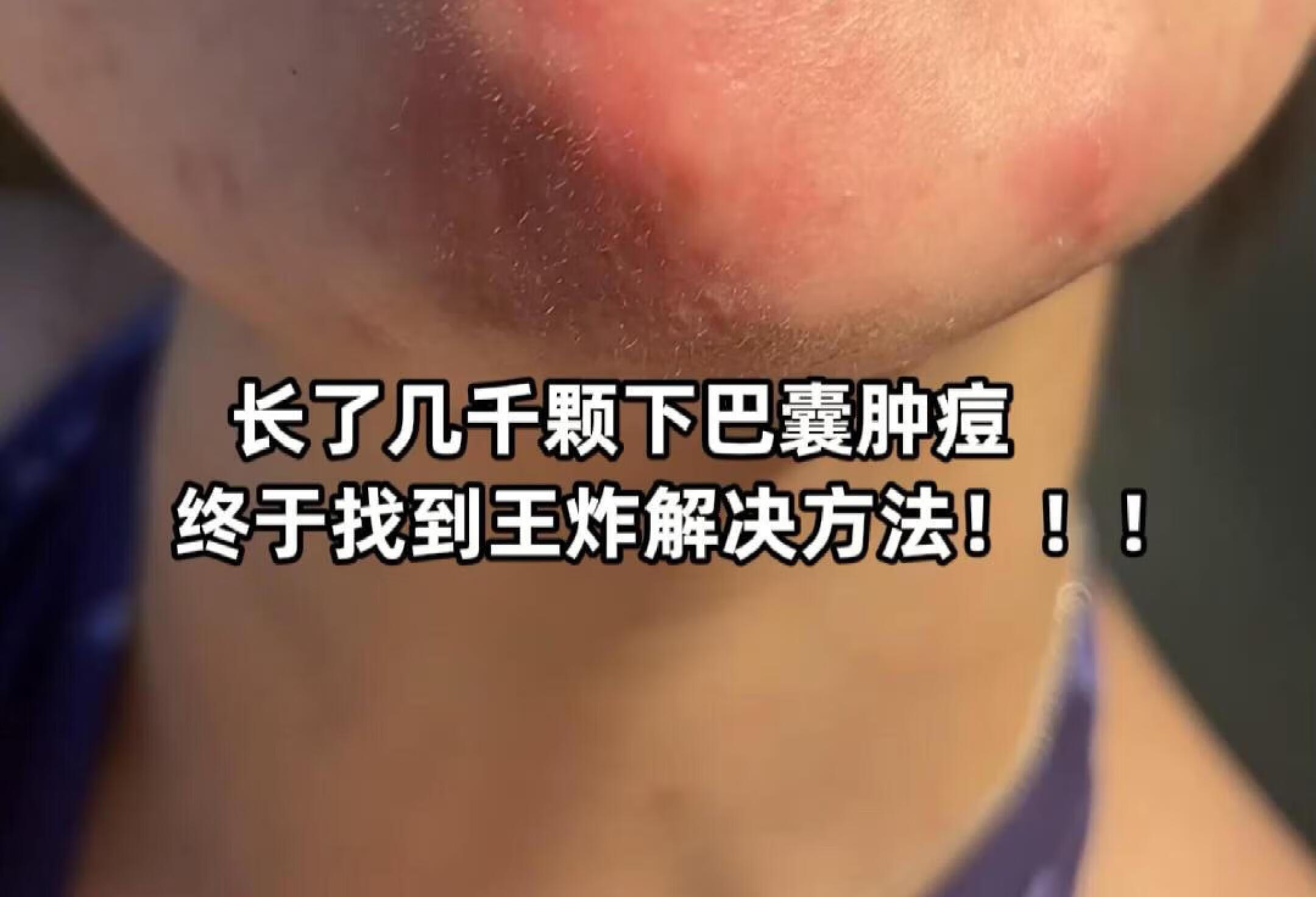 长了几千颗下巴囊肿痘，找到王炸解决方法！