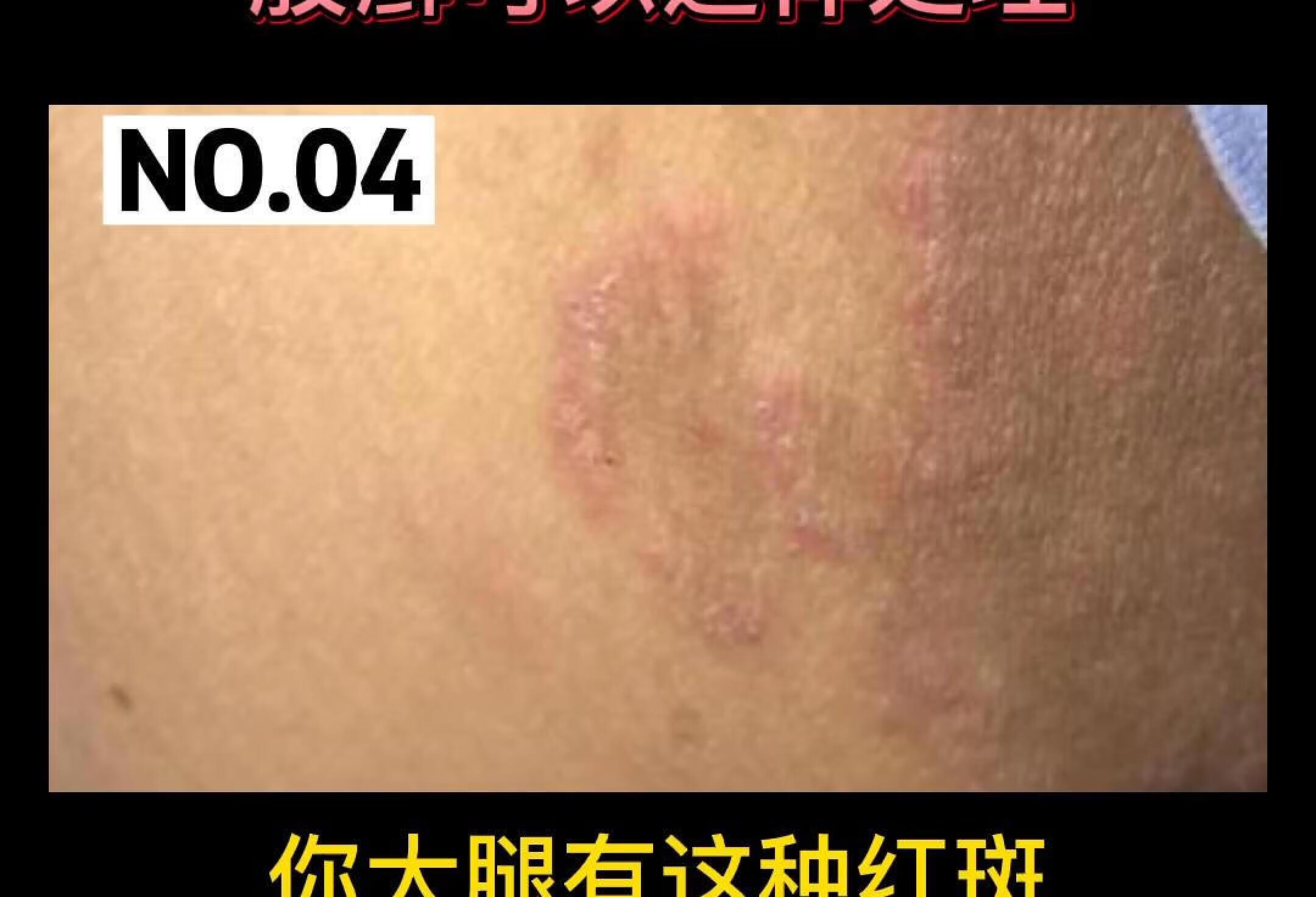 大腿根部出现红斑，股癣可以这样处理