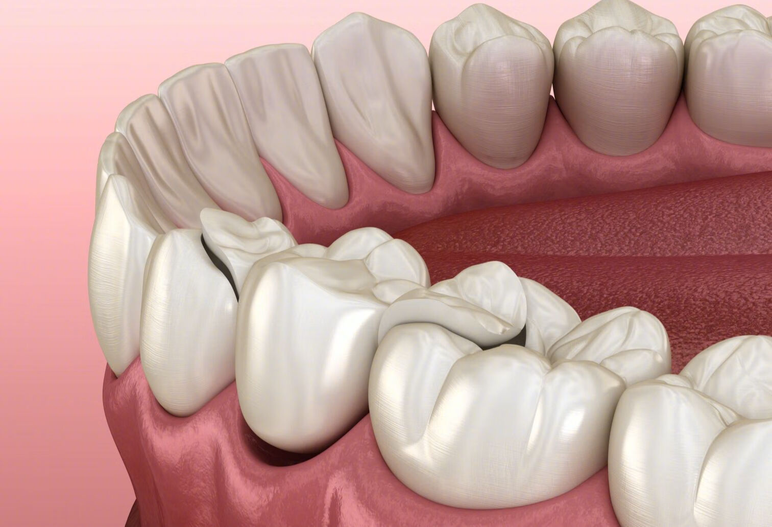 牙齿深覆合，正畸有哪些方法改善？