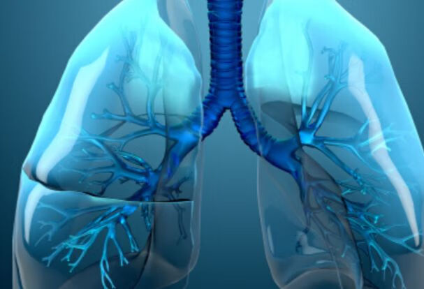什么是肺外结核？