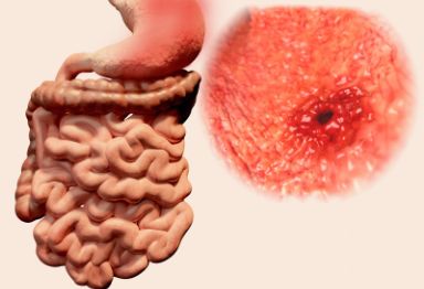 什么是小胃肠间质瘤？