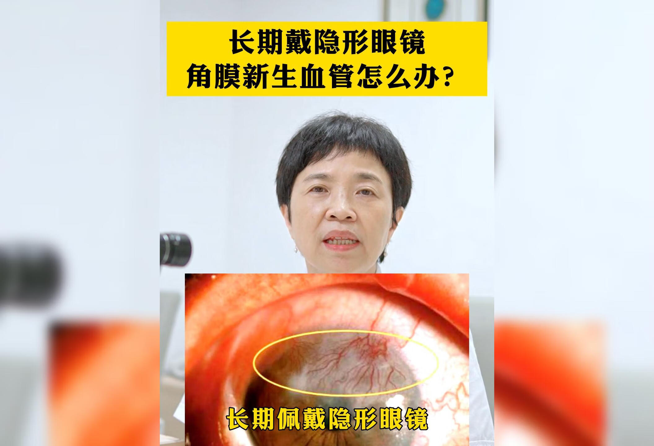 长期戴隐形眼镜，角膜新生血管应该怎么办？