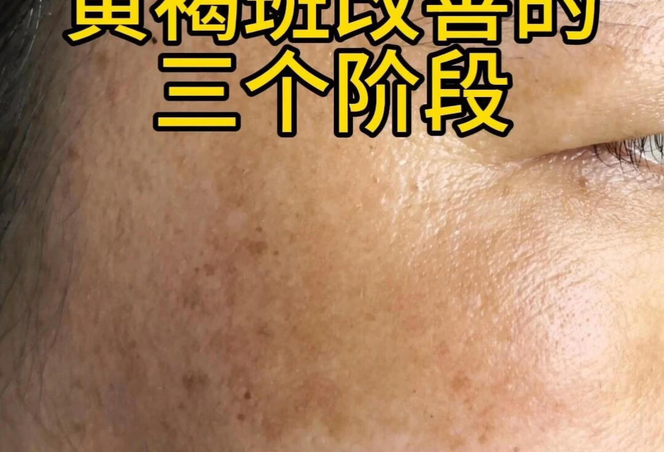 黄褐斑改善的三个阶段