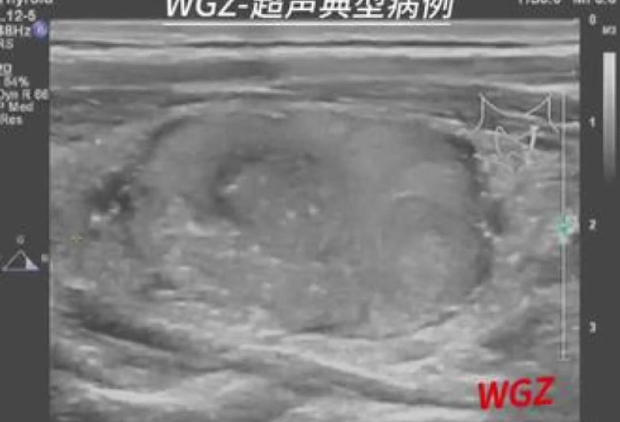 滤泡型甲状腺乳头状癌 超声学习 甲状腺结节 甲状腺癌