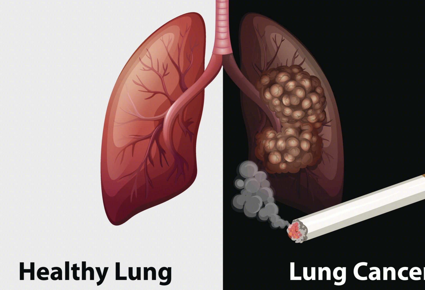 肺癌-上腔静脉综合症√是这样确诊和治疗的！