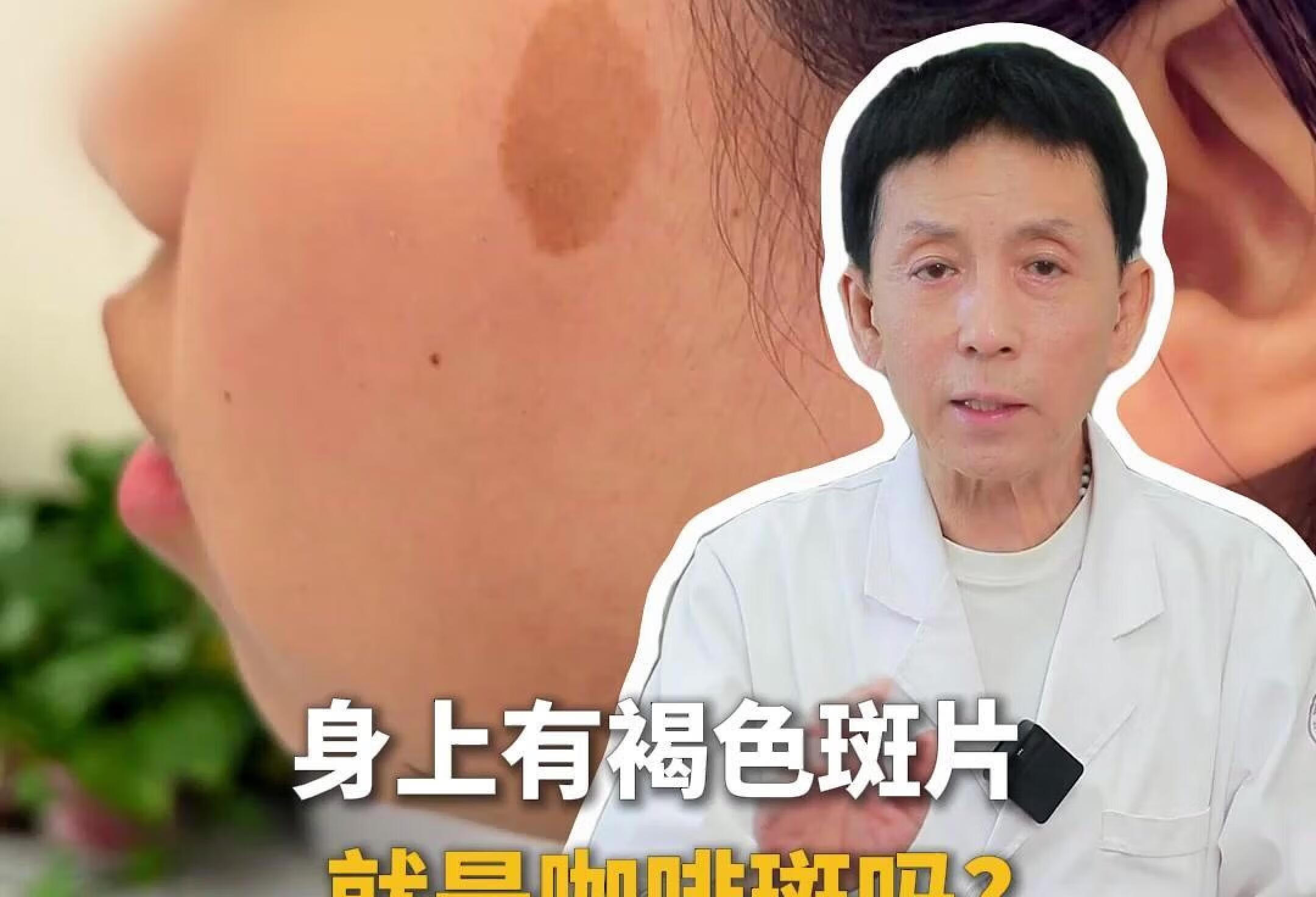 身上有褐色斑片，就是咖啡斑吗？