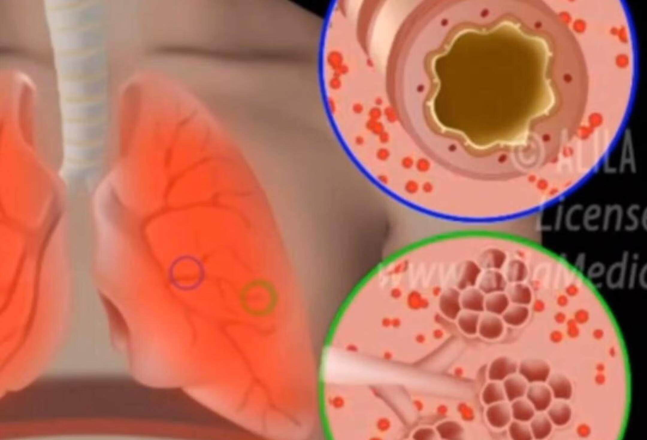 医学英语：慢性阻塞性肺疾病