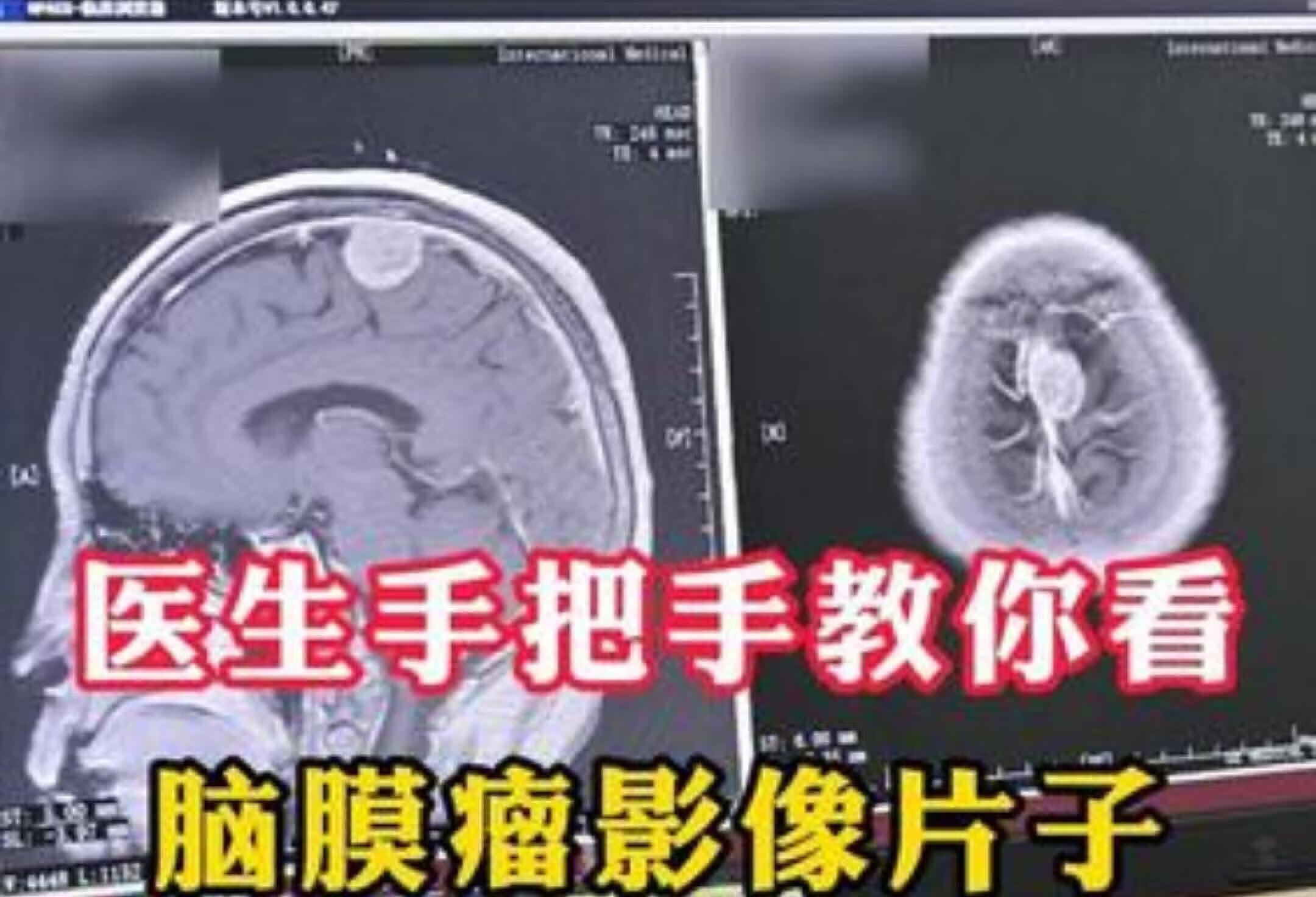 医生手把手教你看脑膜瘤影像