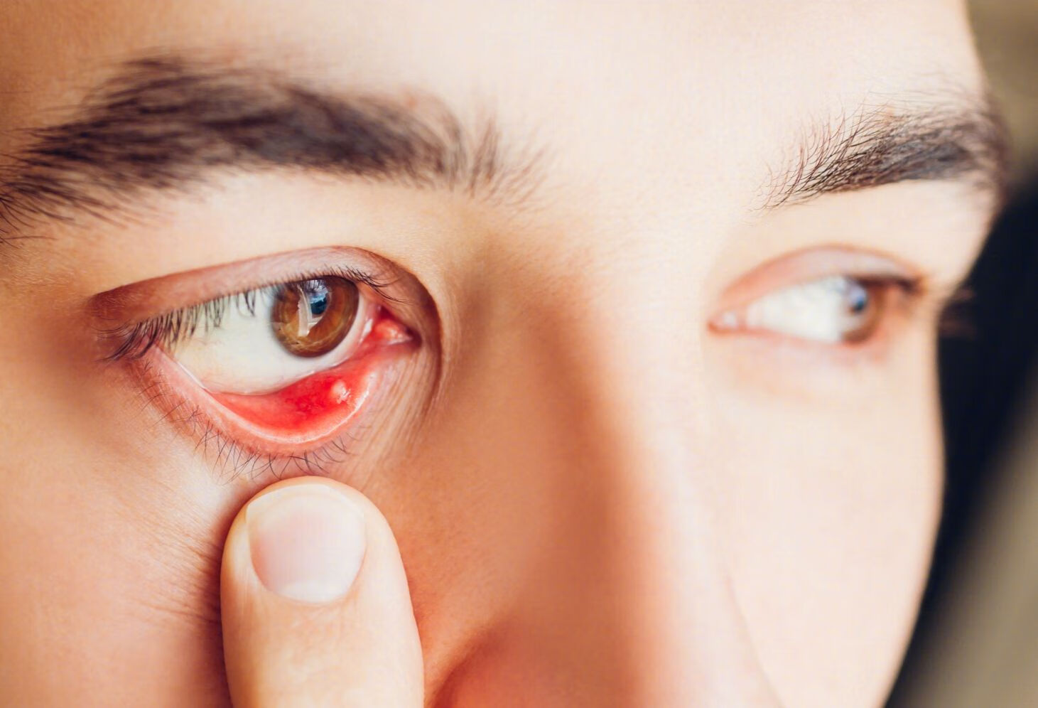 眼睑充血是什么原因？