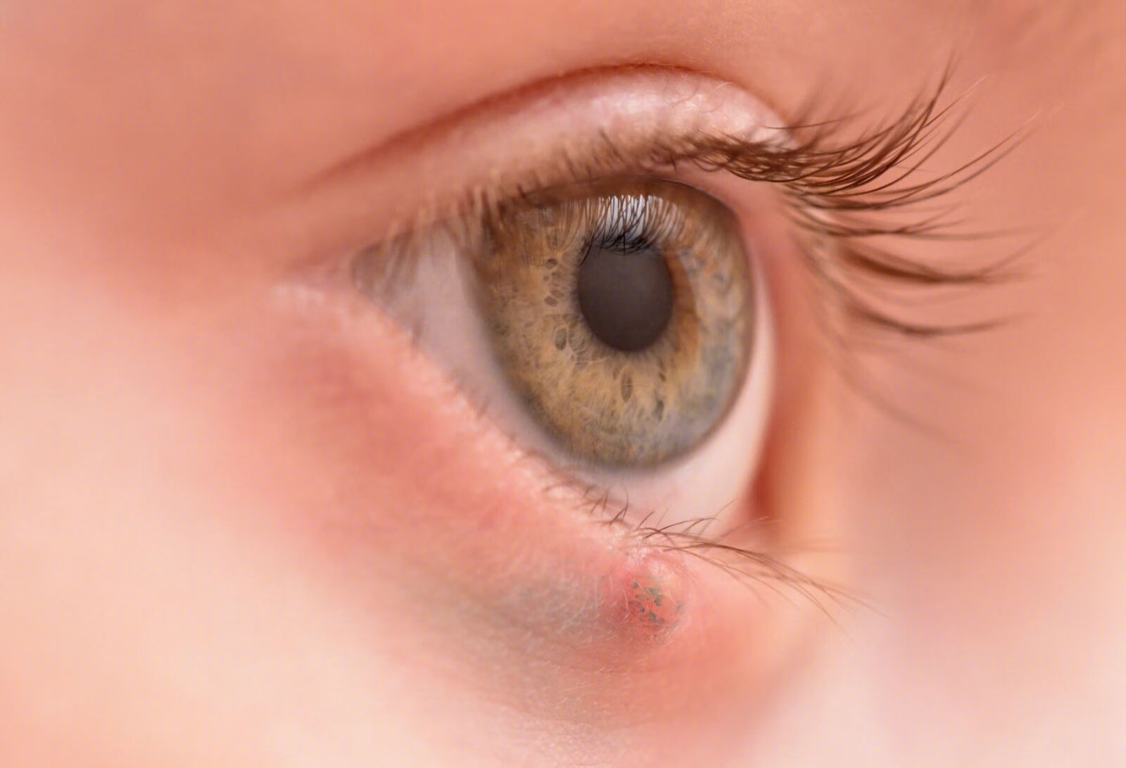 眼睑脓肿怎么治疗？