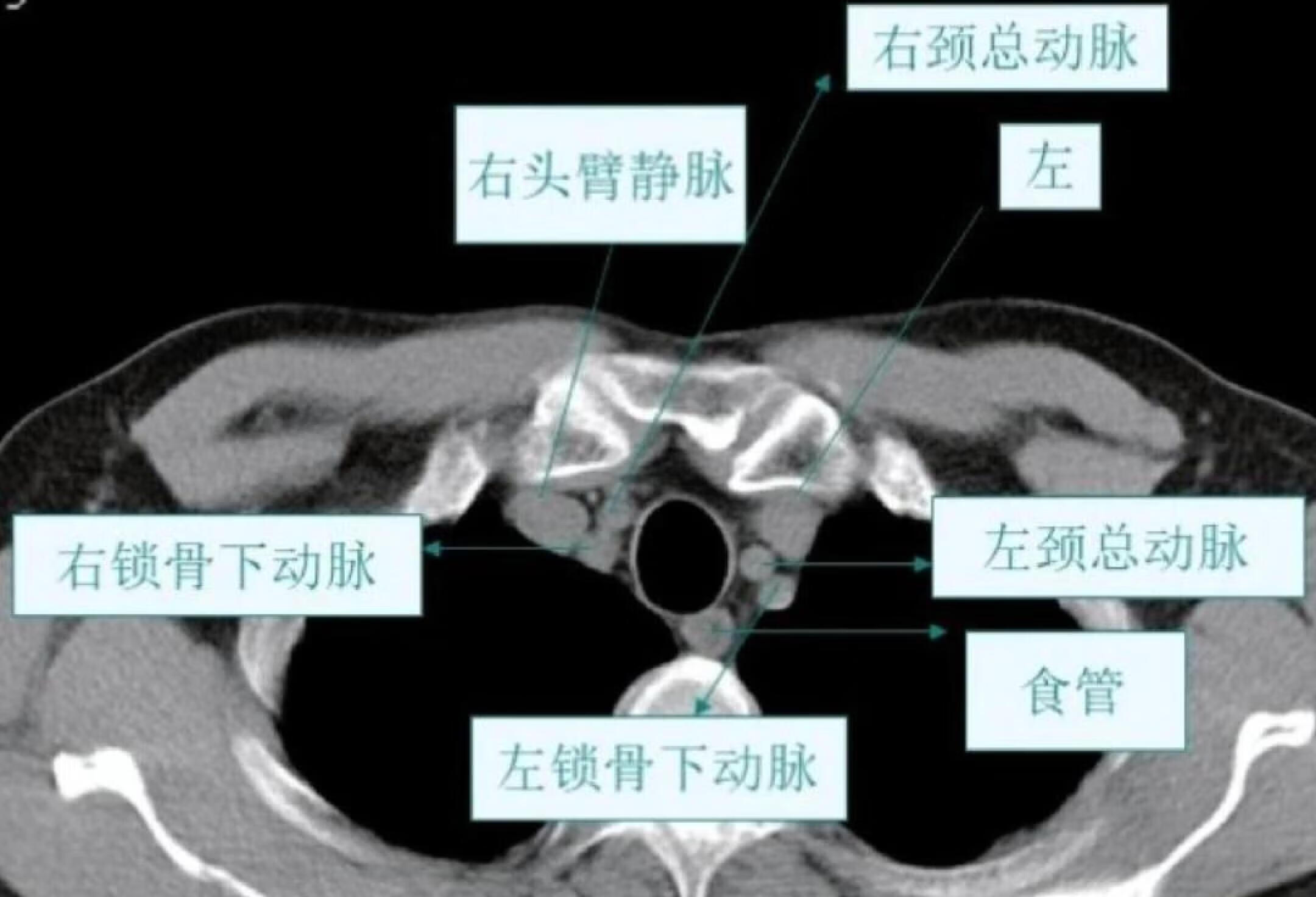 胸部纵隔窗 CT解剖