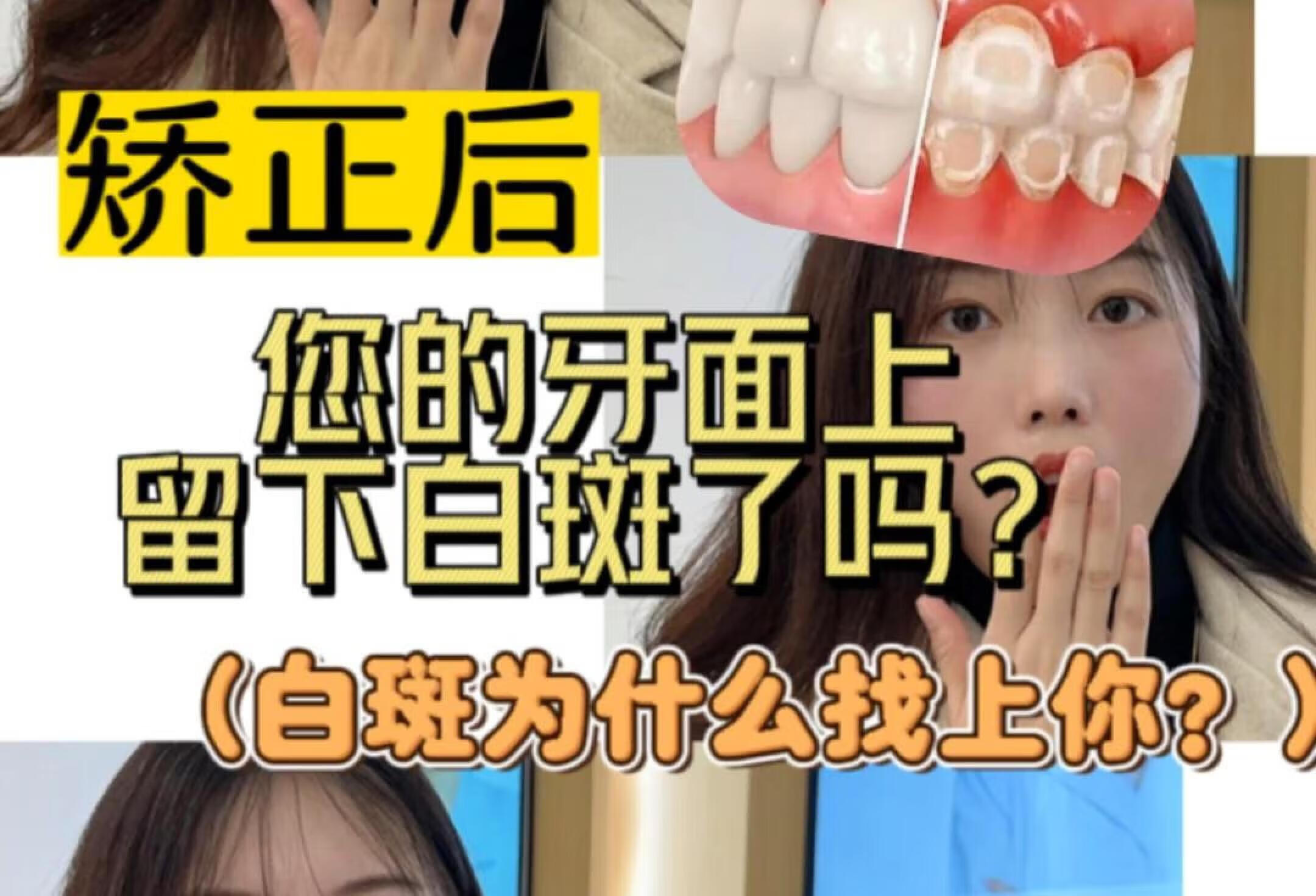 矫正后牙齿上留下白斑❓这是怎么回事