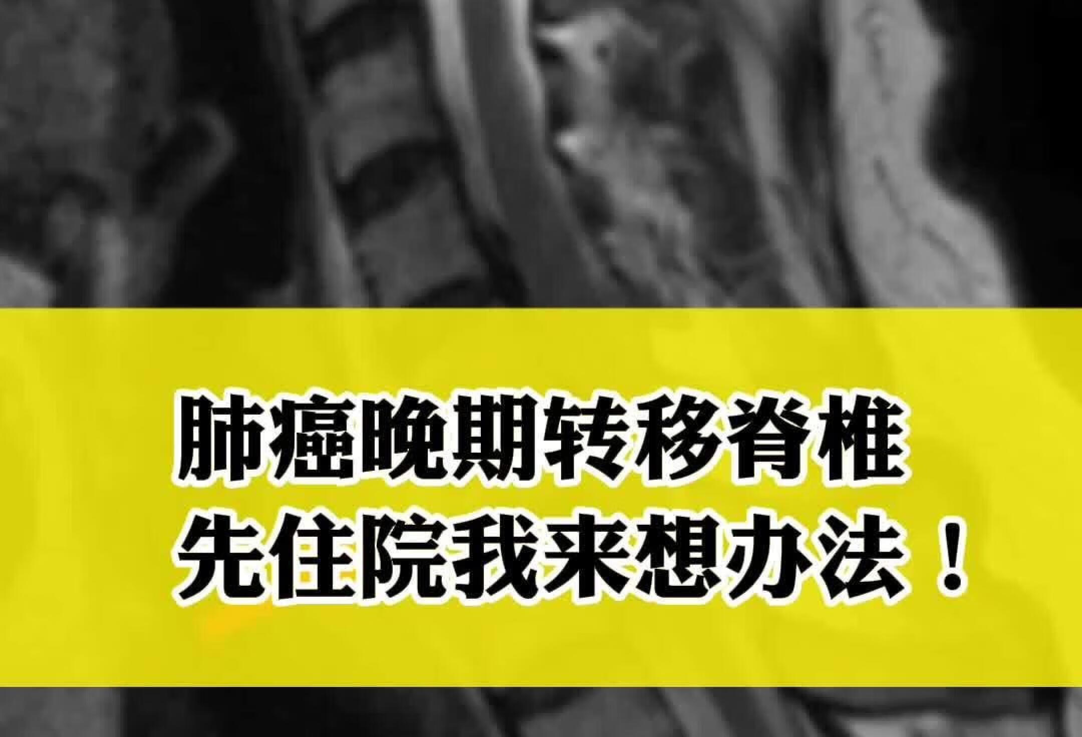 肺癌晚期转移脊椎 先住院我来想办法！