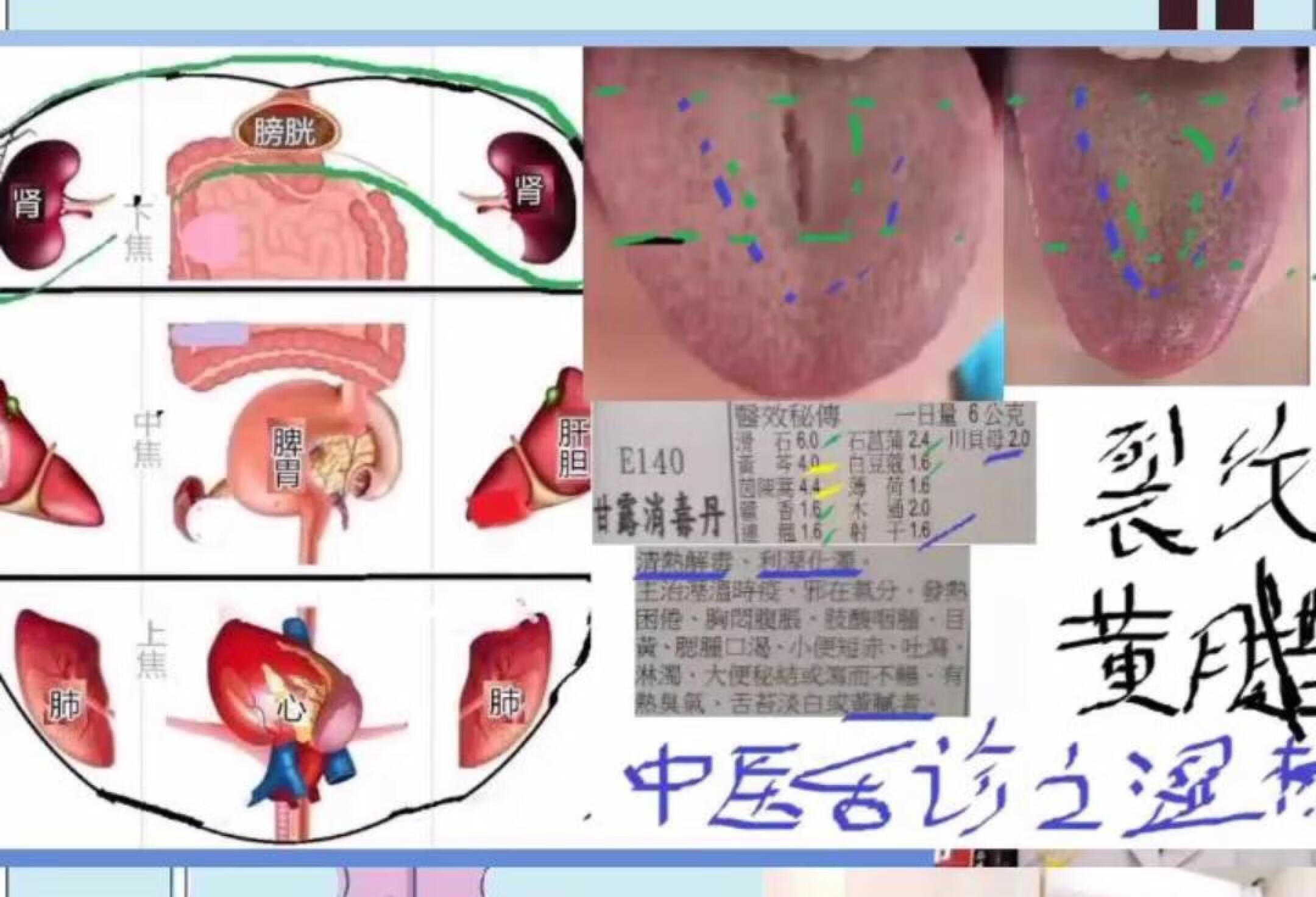 裂纹舌湿热型 中医舌诊经方