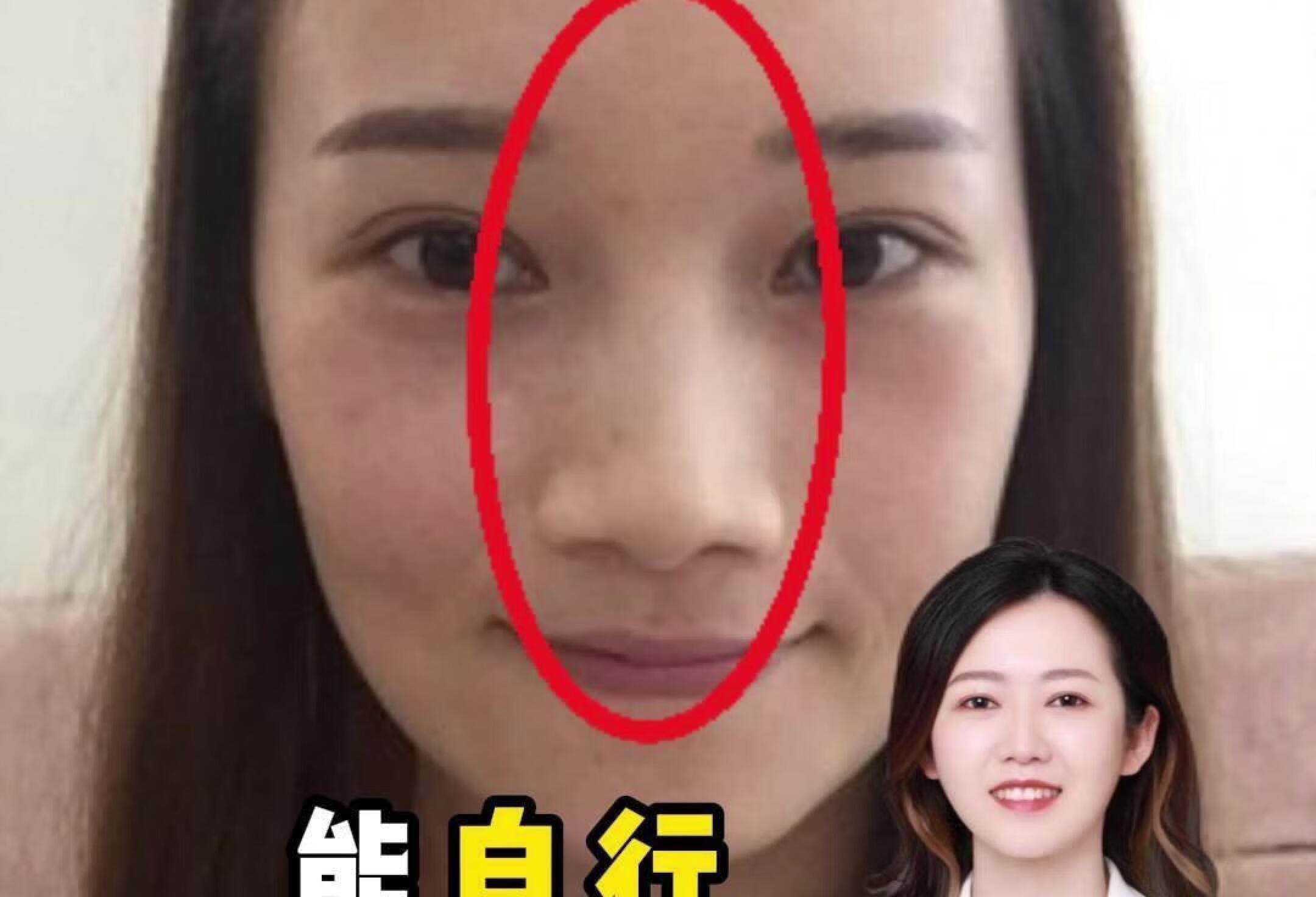 鼻梁骨折后能自行恢复吗? 医生：想法很好