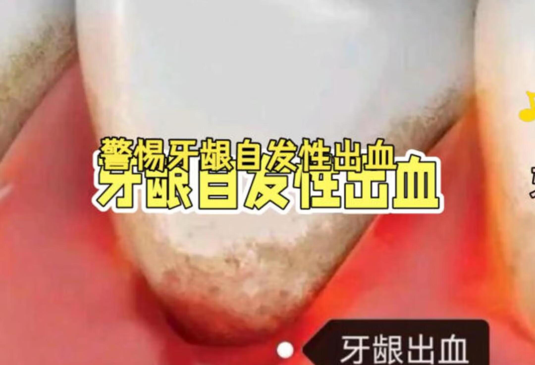 牙龈出血