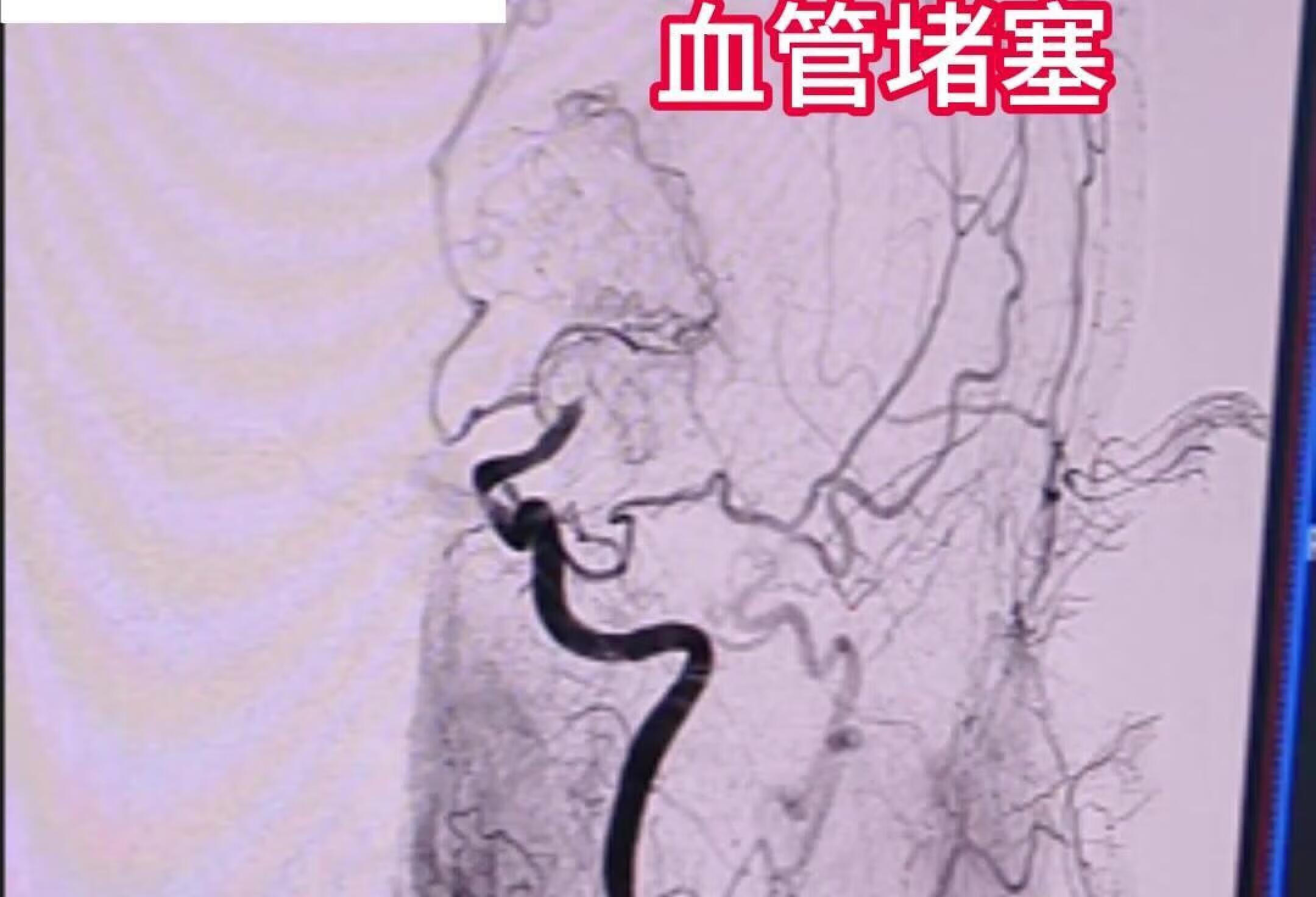 67岁老人取栓成功，突发右侧肢体活动不灵。