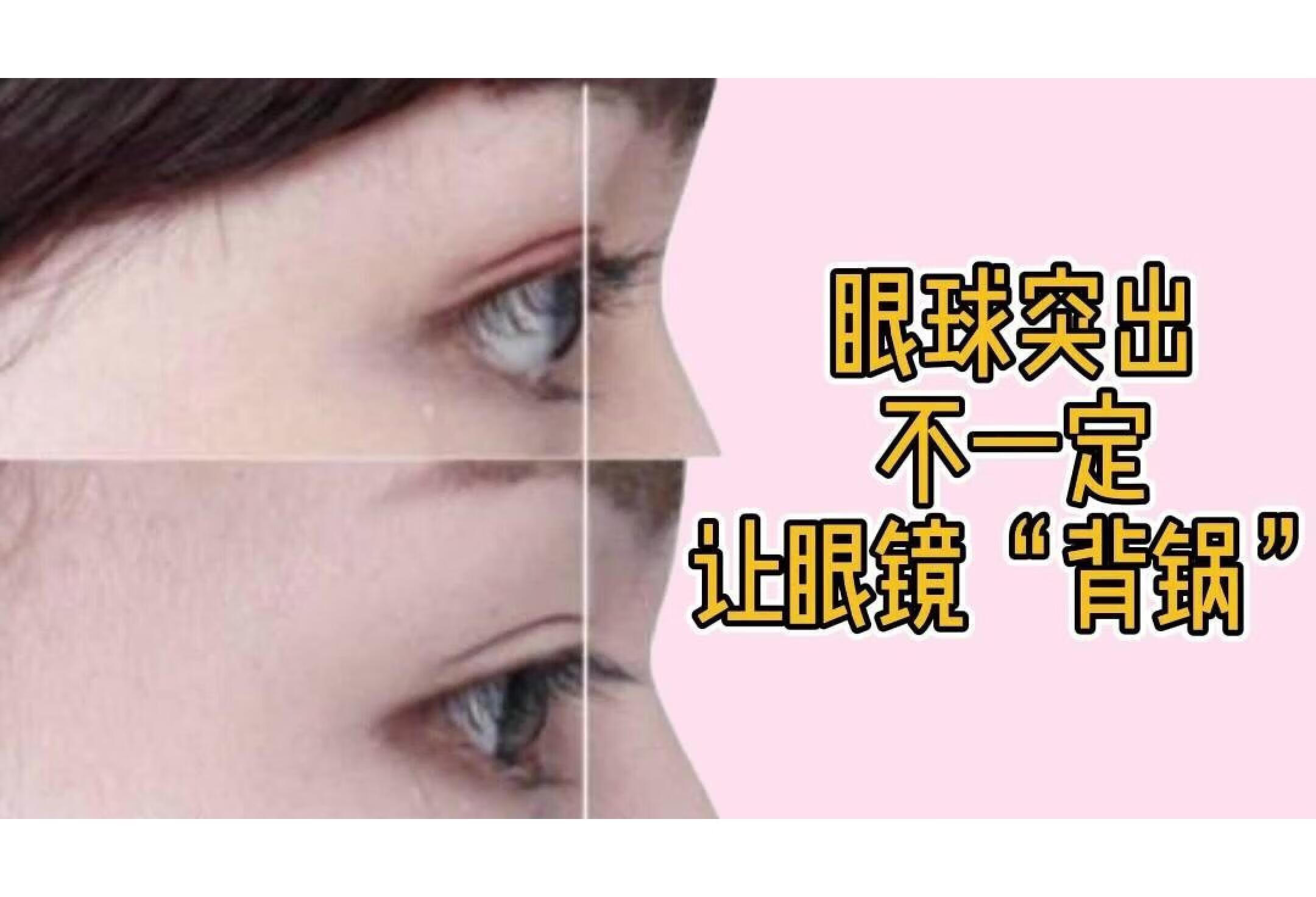 眼球突出不一定让眼镜“背锅”