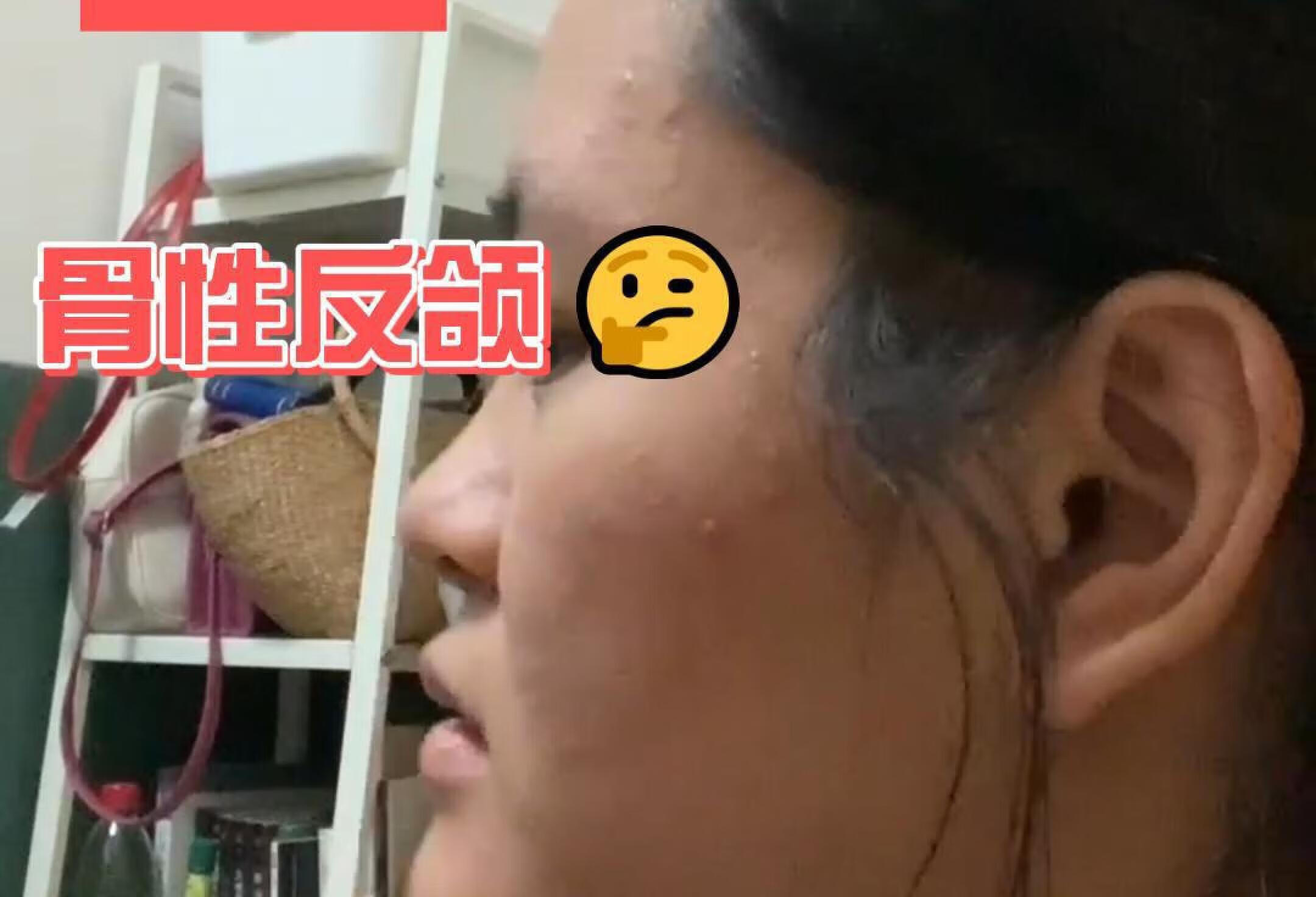 骨性反颌掩饰性正畸后颌面？我：请看vcr