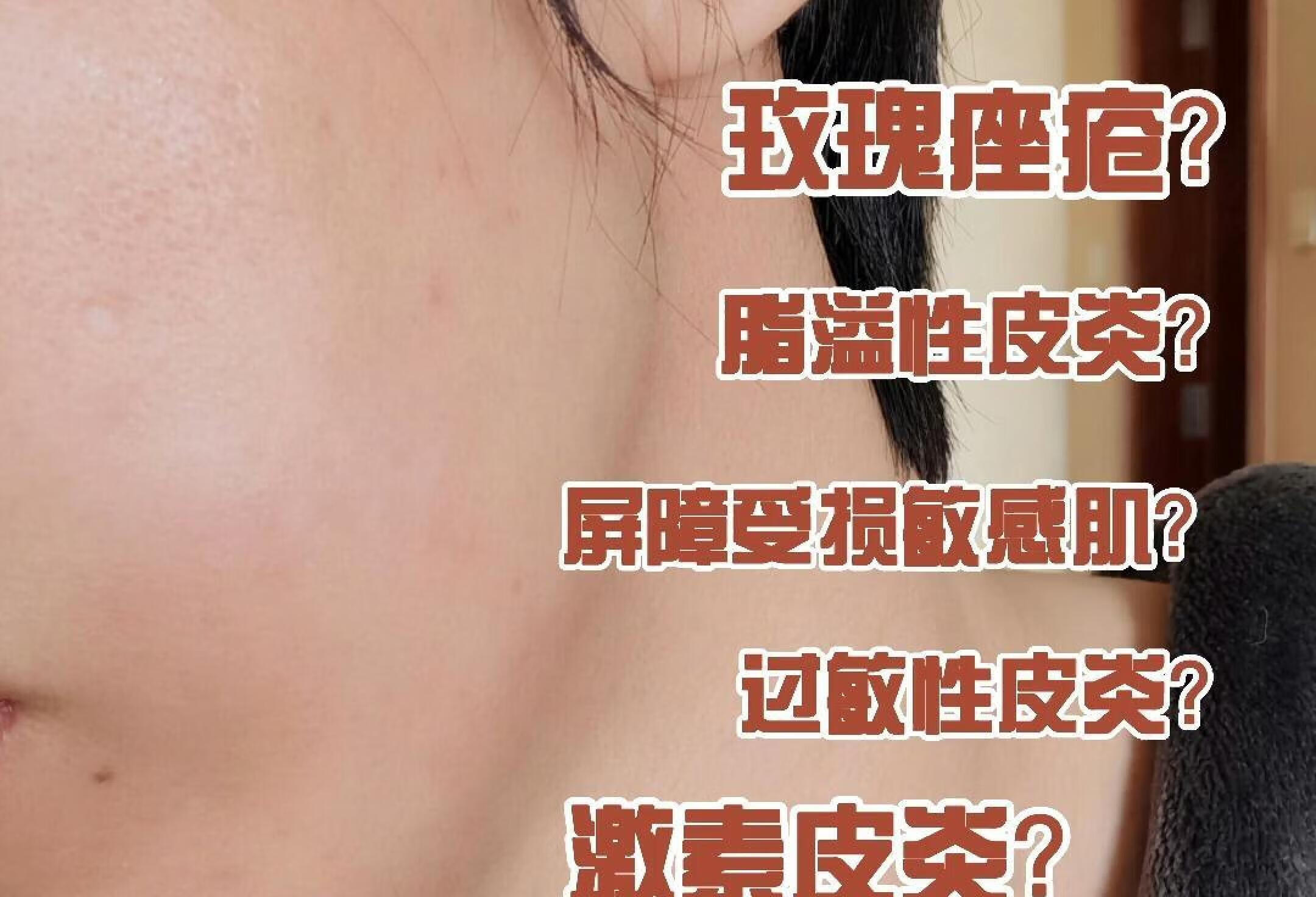 你是哪一种皮肤问题？|屏障受损