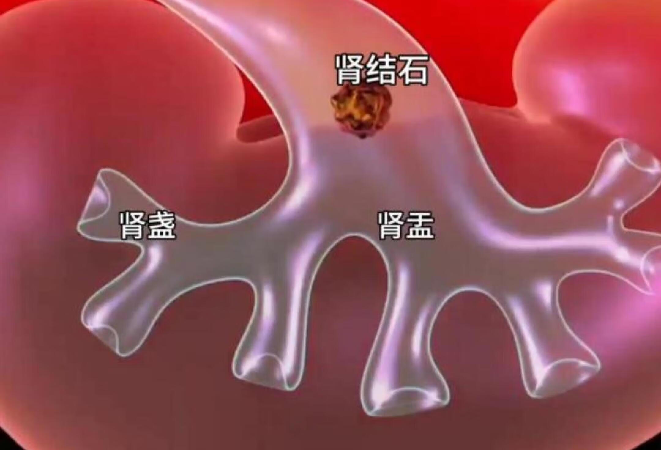 超声波碎石过程，3D演示。。