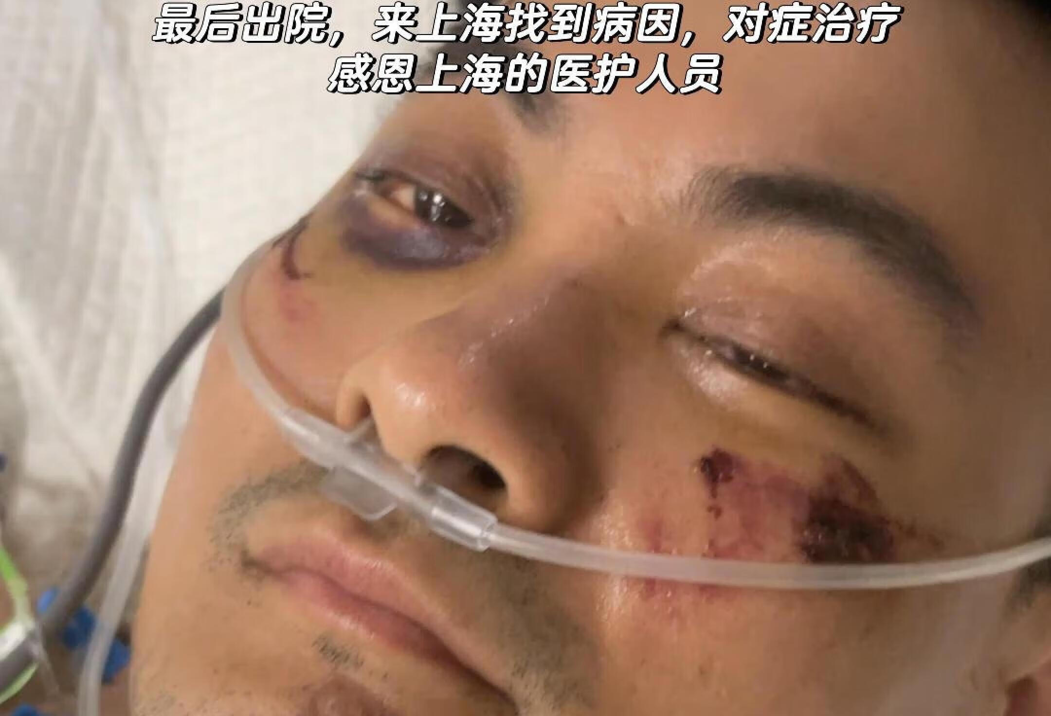 骨折并发症的可怕和高死亡率