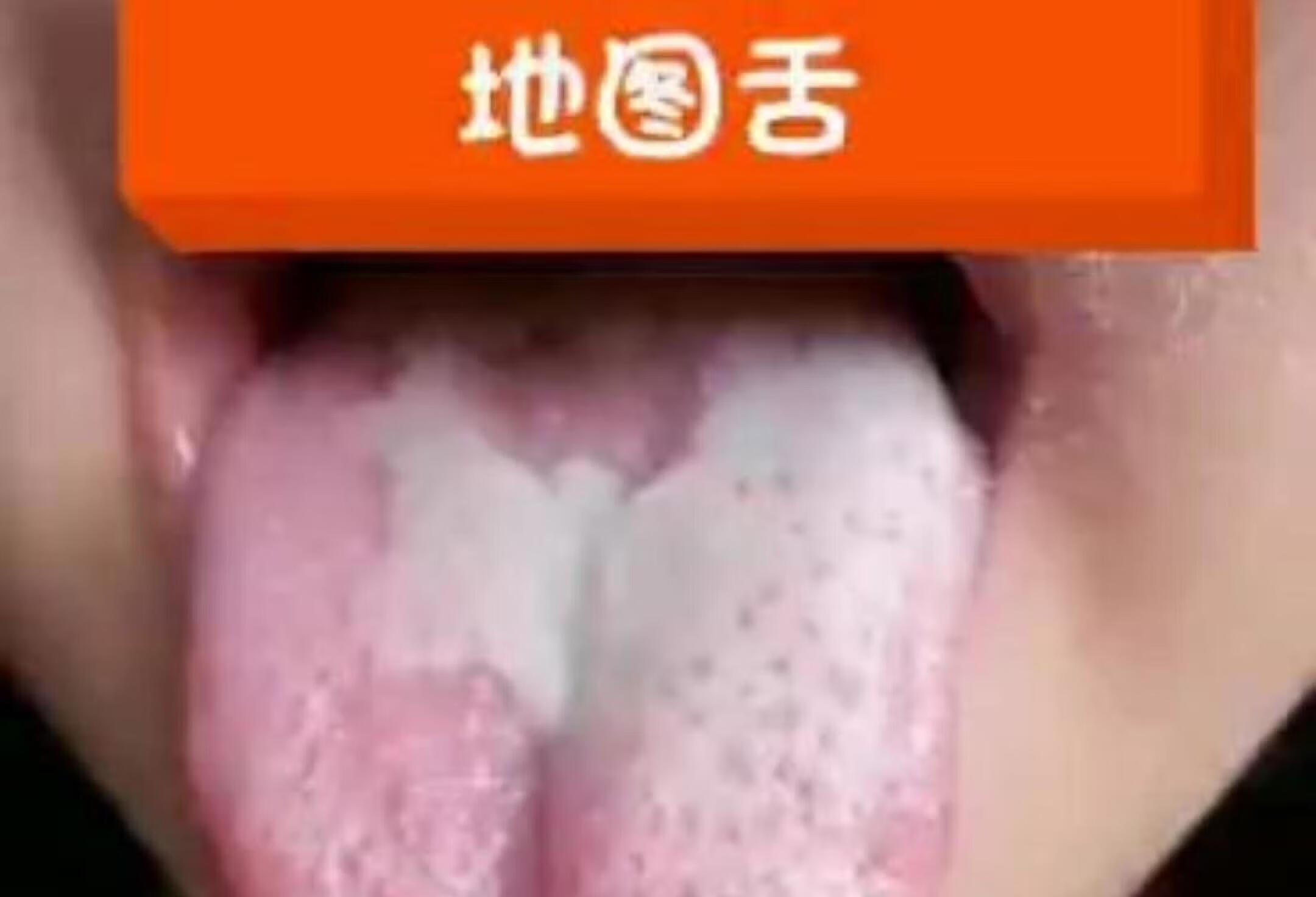 你家宝宝的舌苔是什么样的？