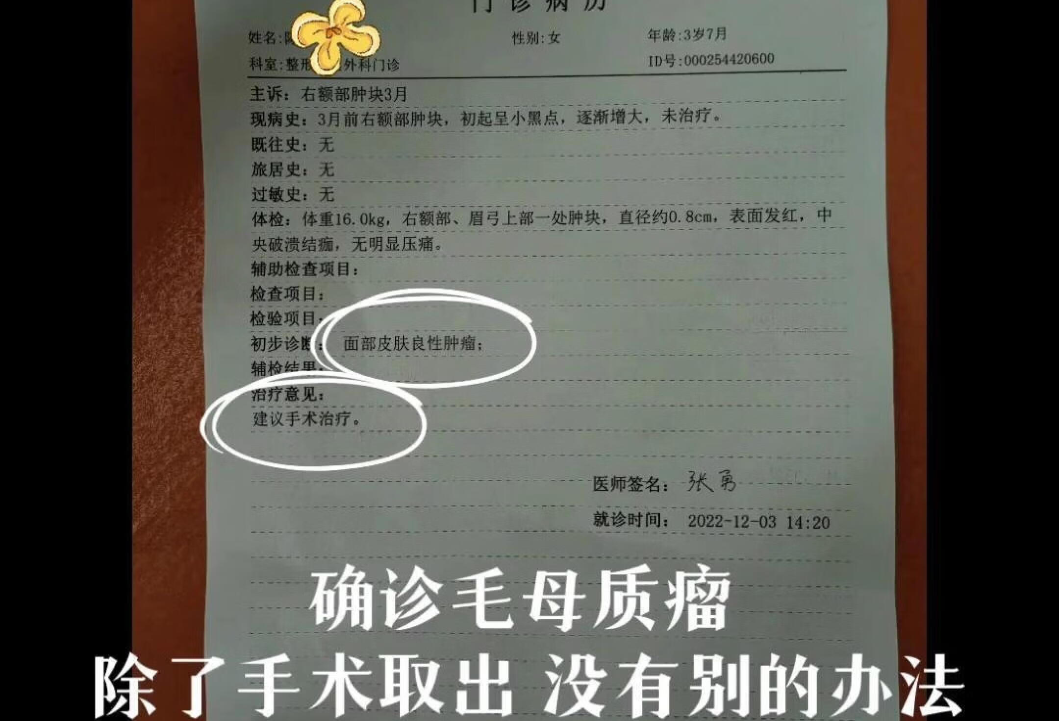 毛母质瘤住院实录1 现在又复发了😭