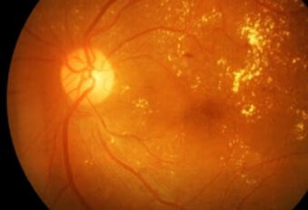 视野检查针对什么病？