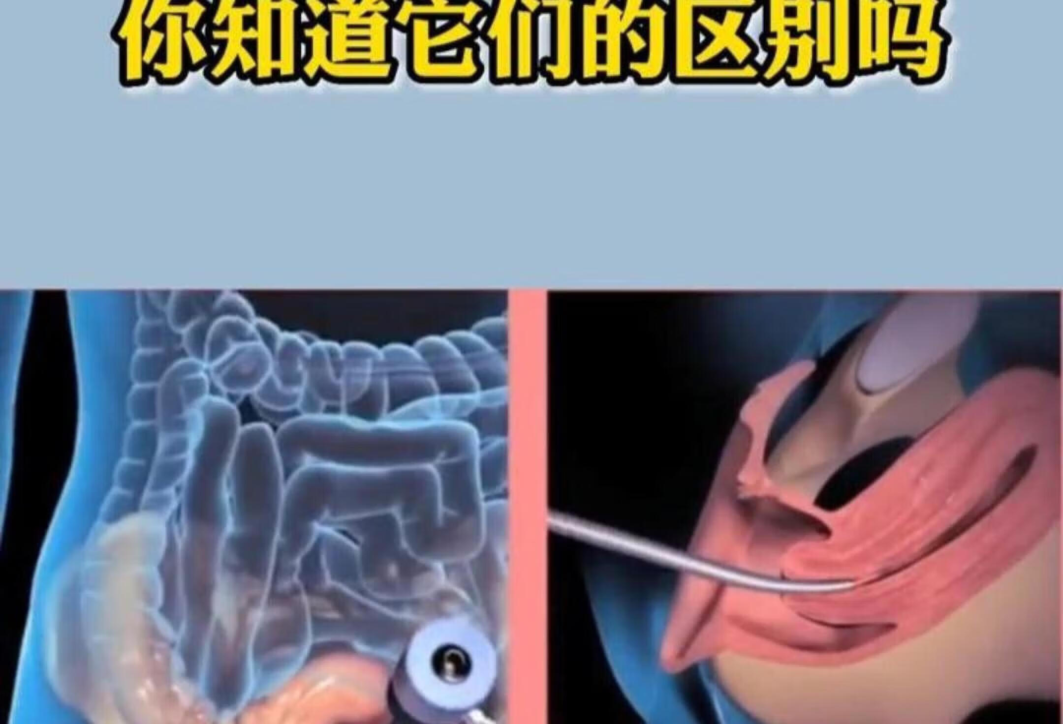 腹腔妊娠