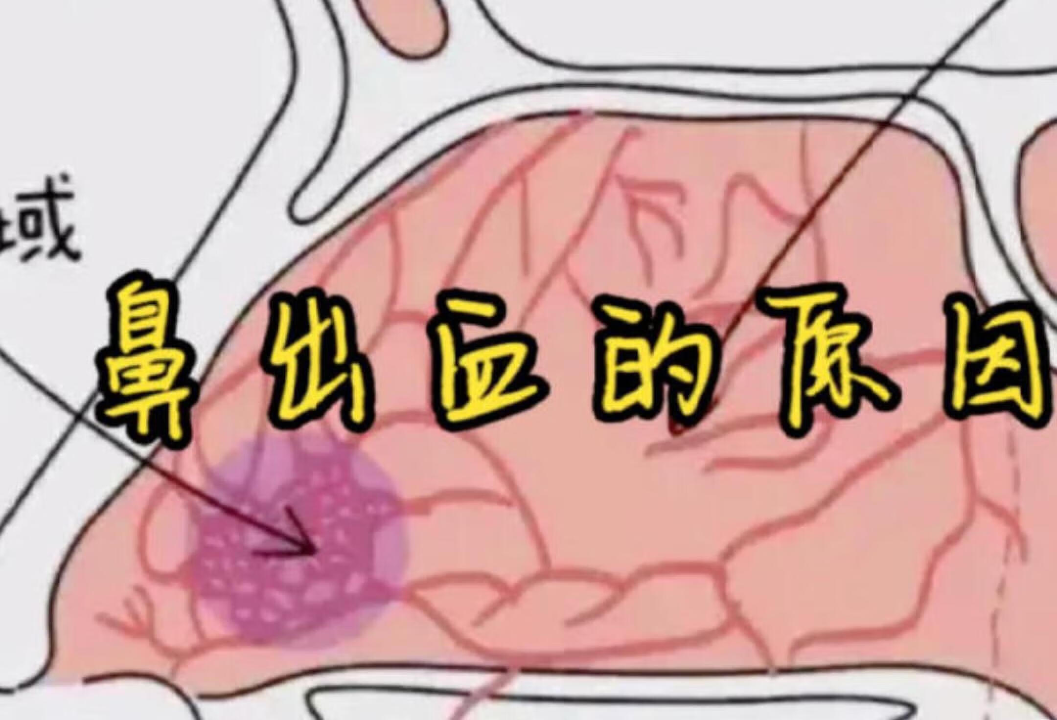 儿童鼻出血的原因