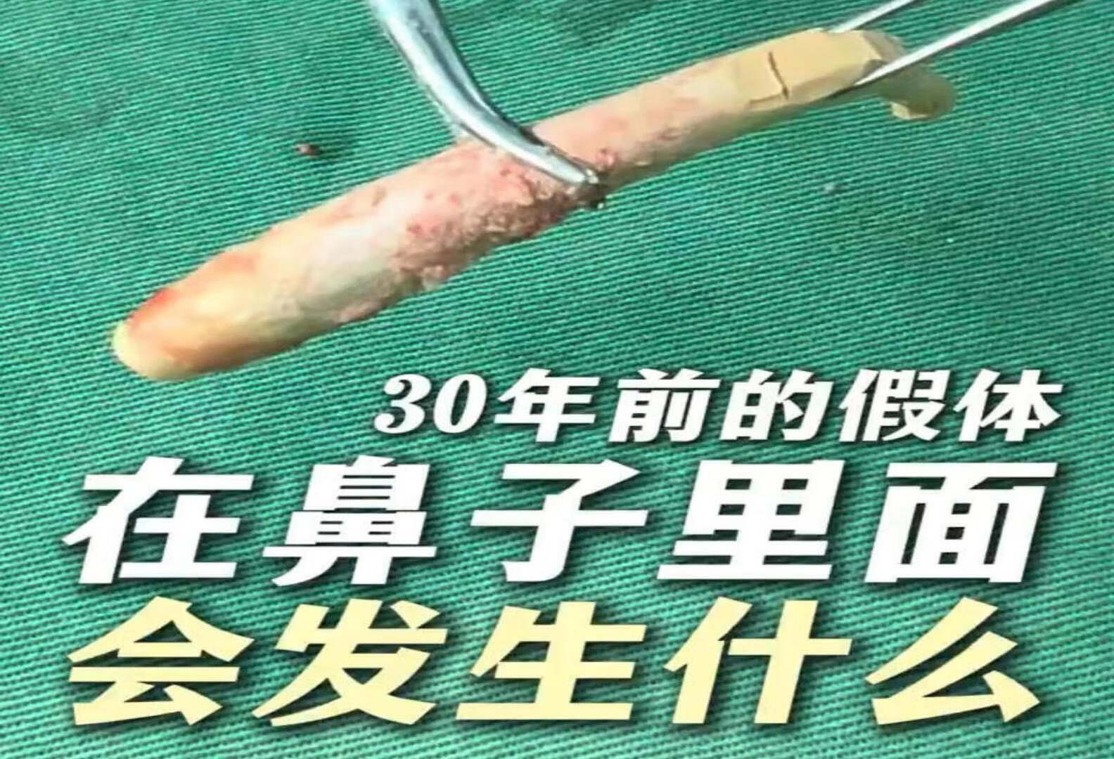 30年的假体在鼻子里面会发生什么？