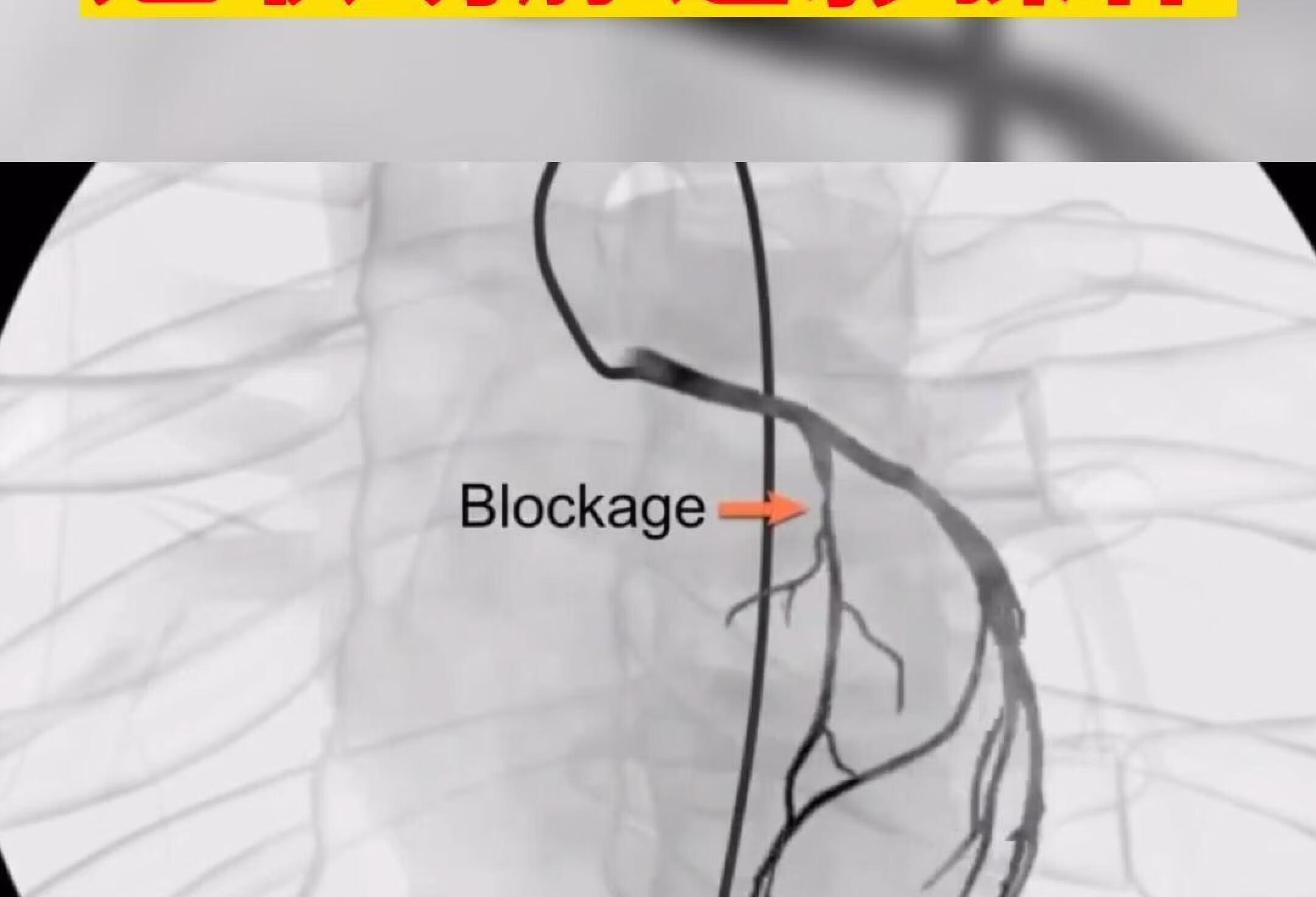 动画演示，冠状动脉造影操作。