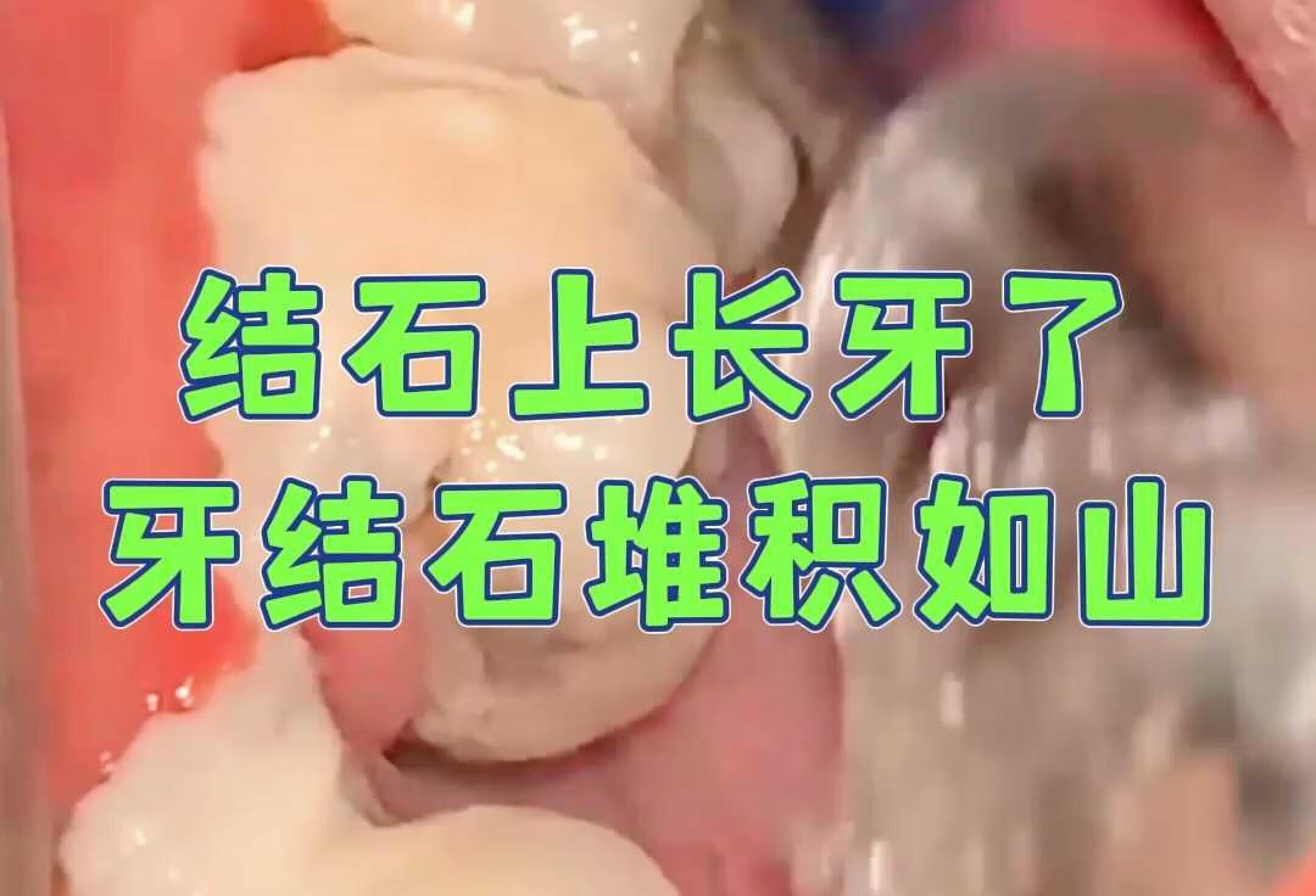 结石上长牙了？牙结石堆积如山！​