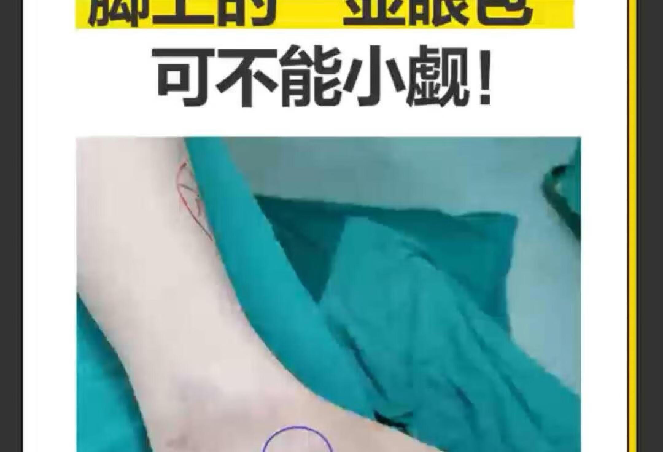 脚🦶上出现显眼包千万别忽视