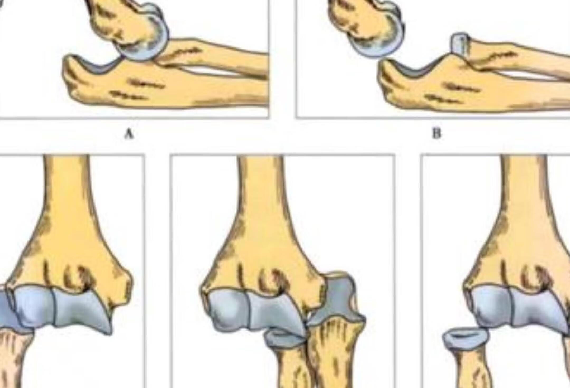医学科普 肘关节分型
