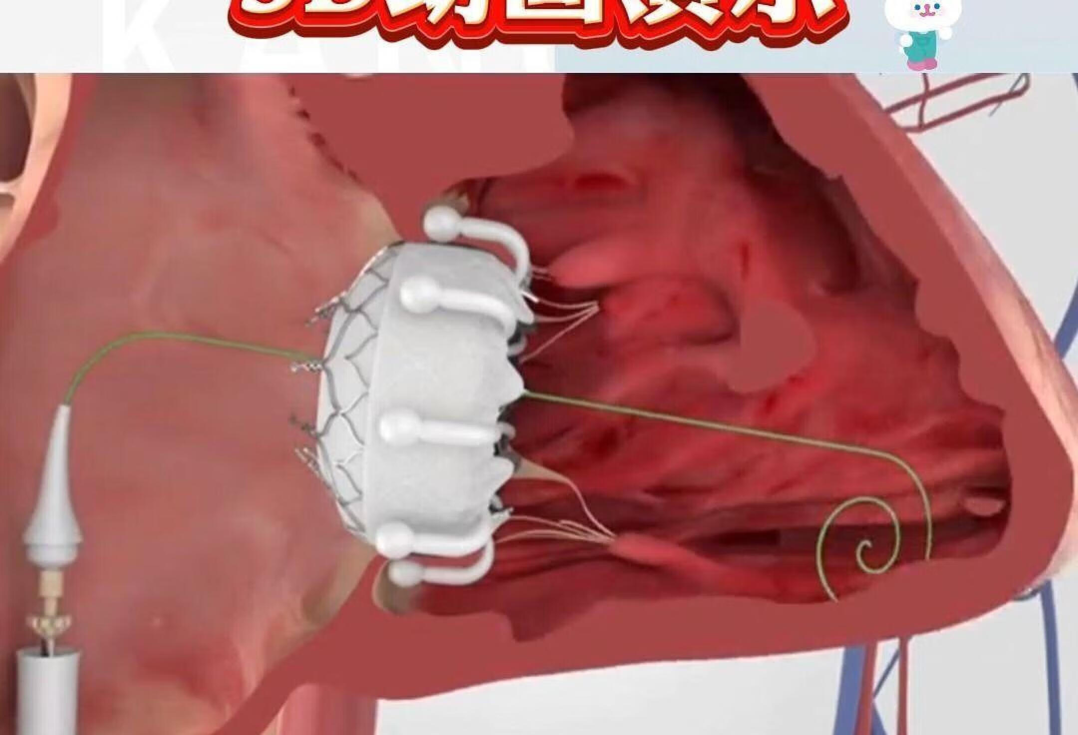 动脉导管未闭3D动画演示