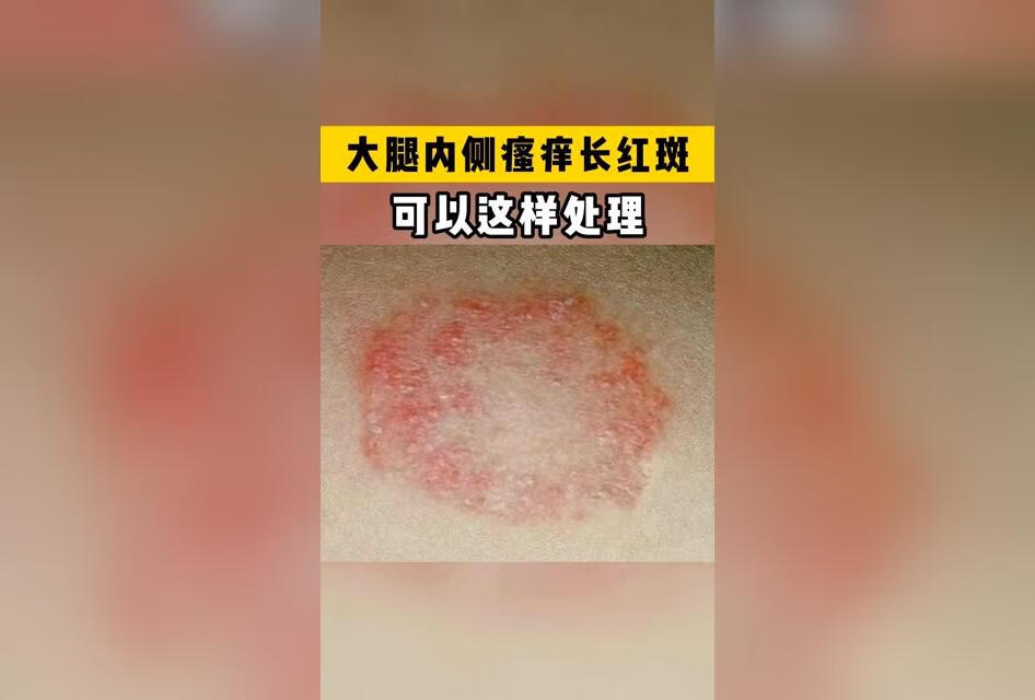 才抠完脚，你就去抓大腿根，股癣你不得谁得