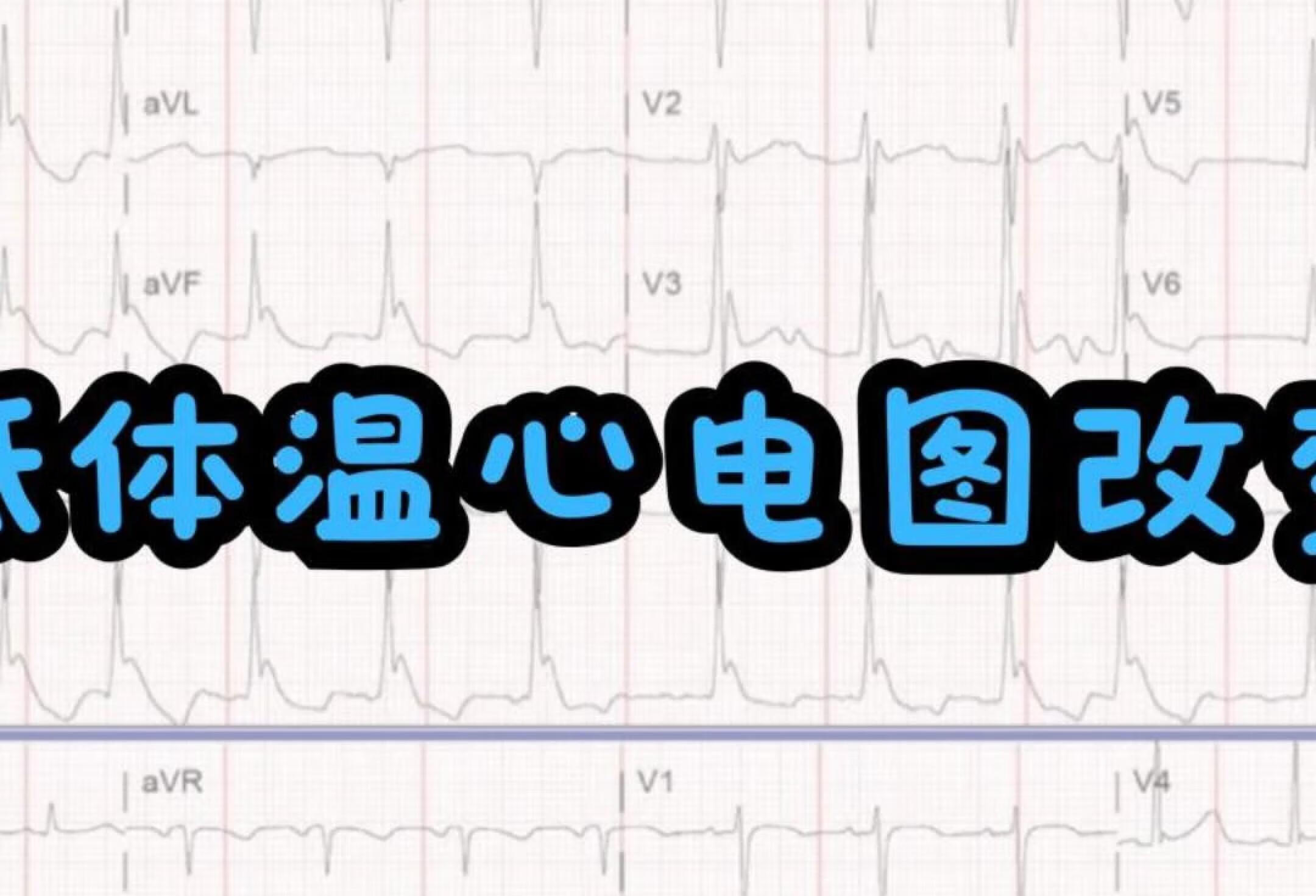 心电图病例分析--低体温心电图改变