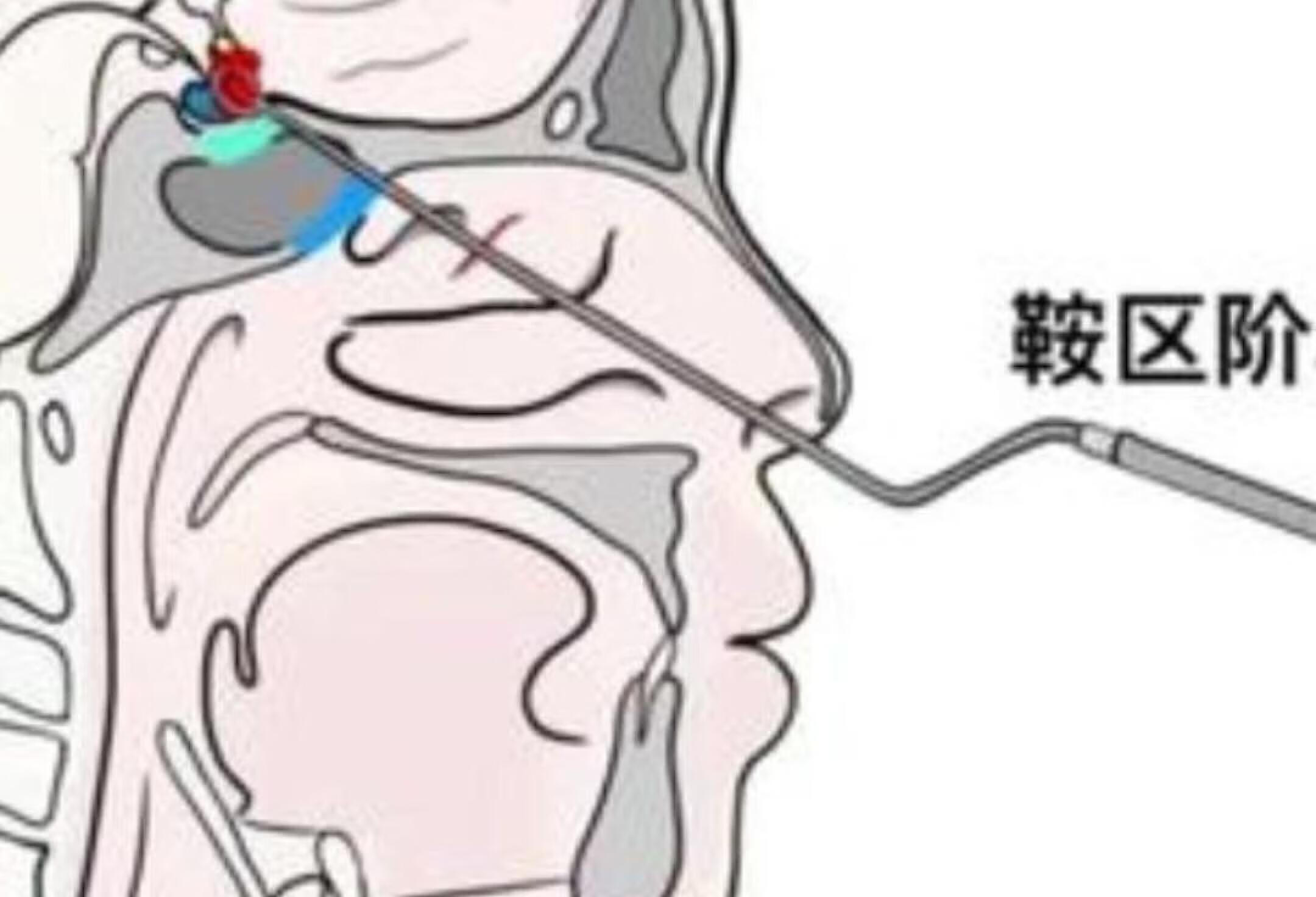 12秒感受经鼻垂体瘤切除术