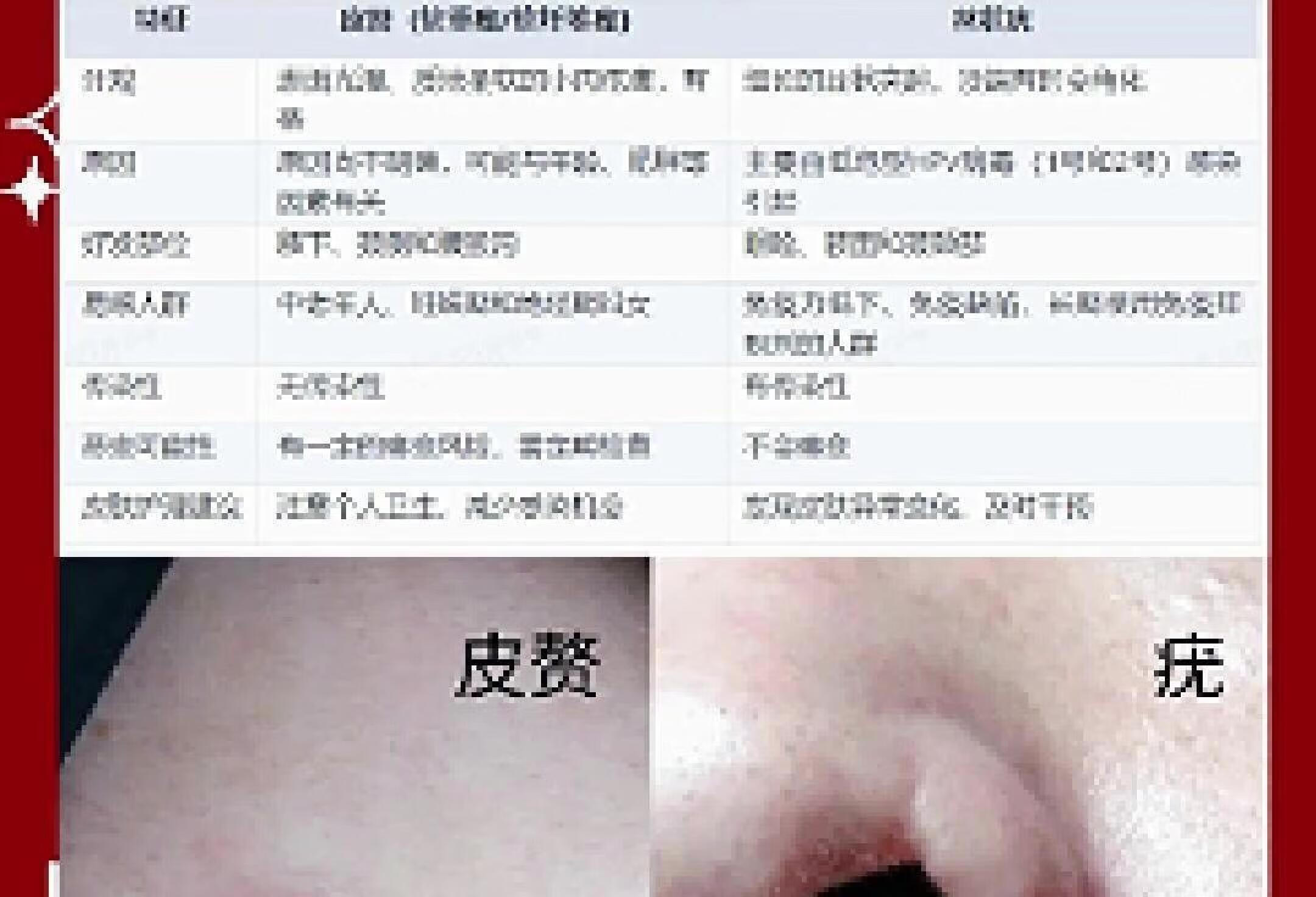 皮赘与丝状疣，良性皮肤赘生物的区分宝典