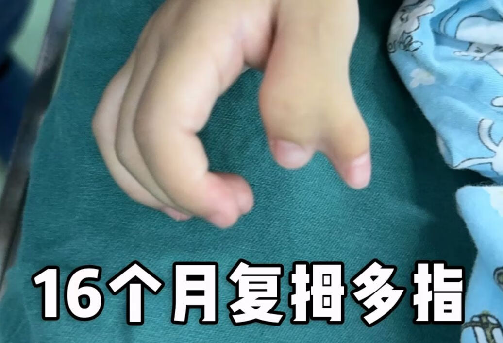 16个月的宝宝复拇多指