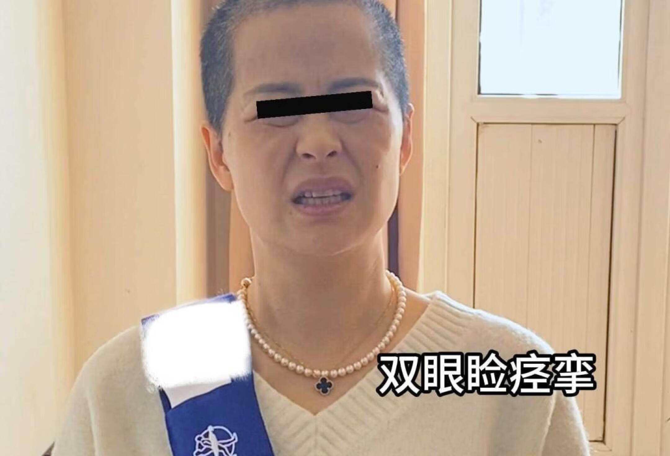 梅杰综合征有什么表现？