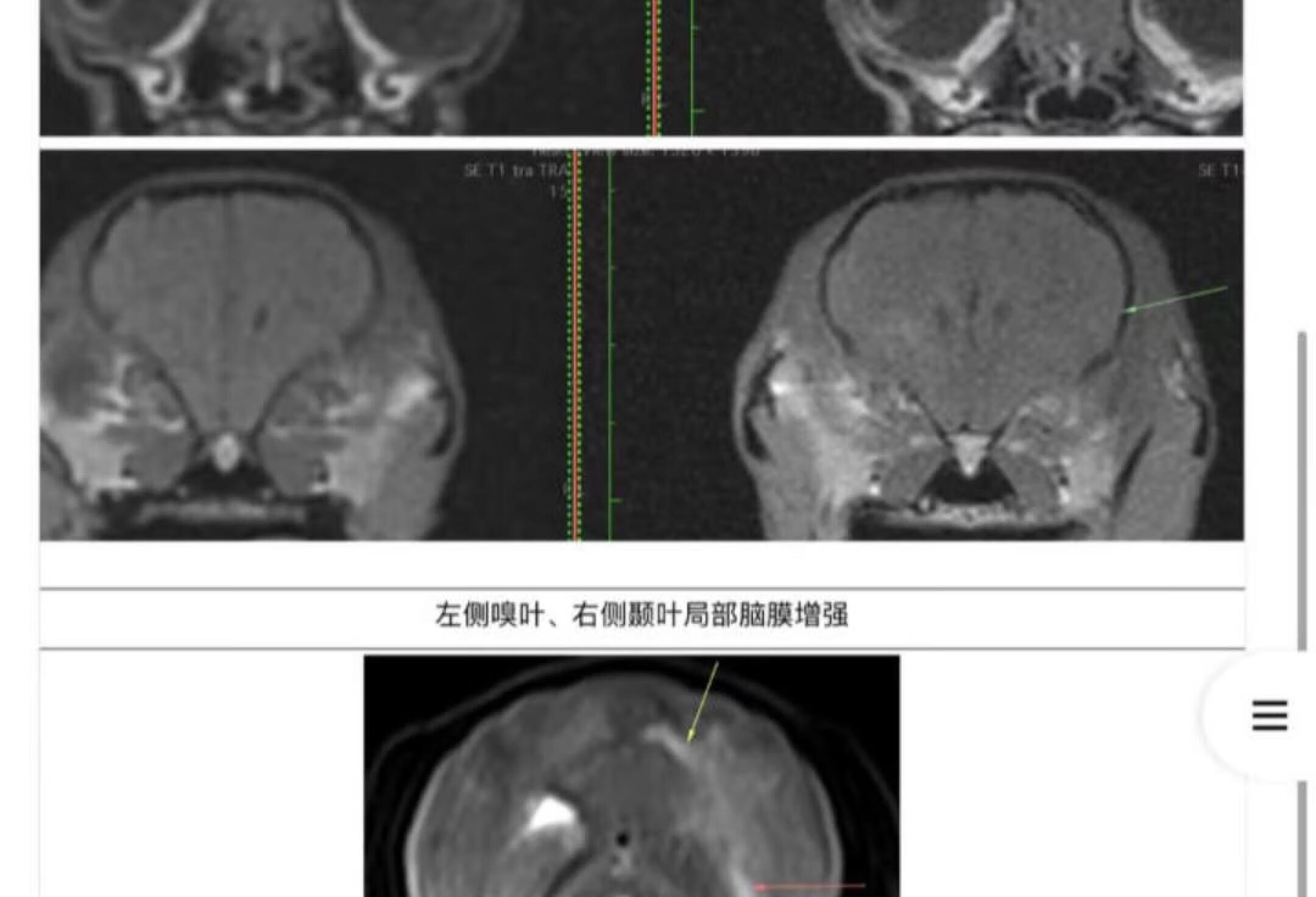 脑干脑炎