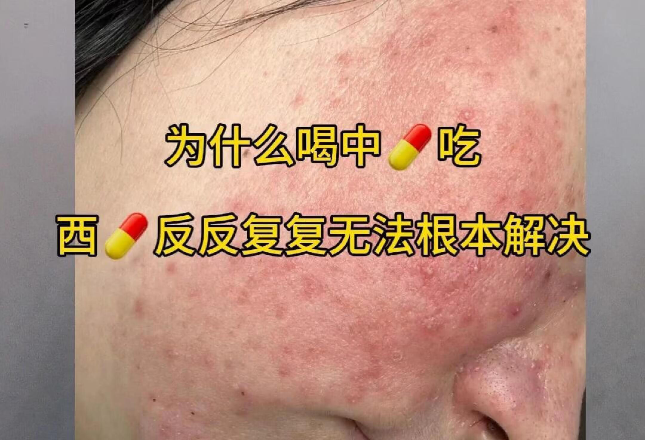 为什么吃那么多中西💊？激素脸敏感肌不好