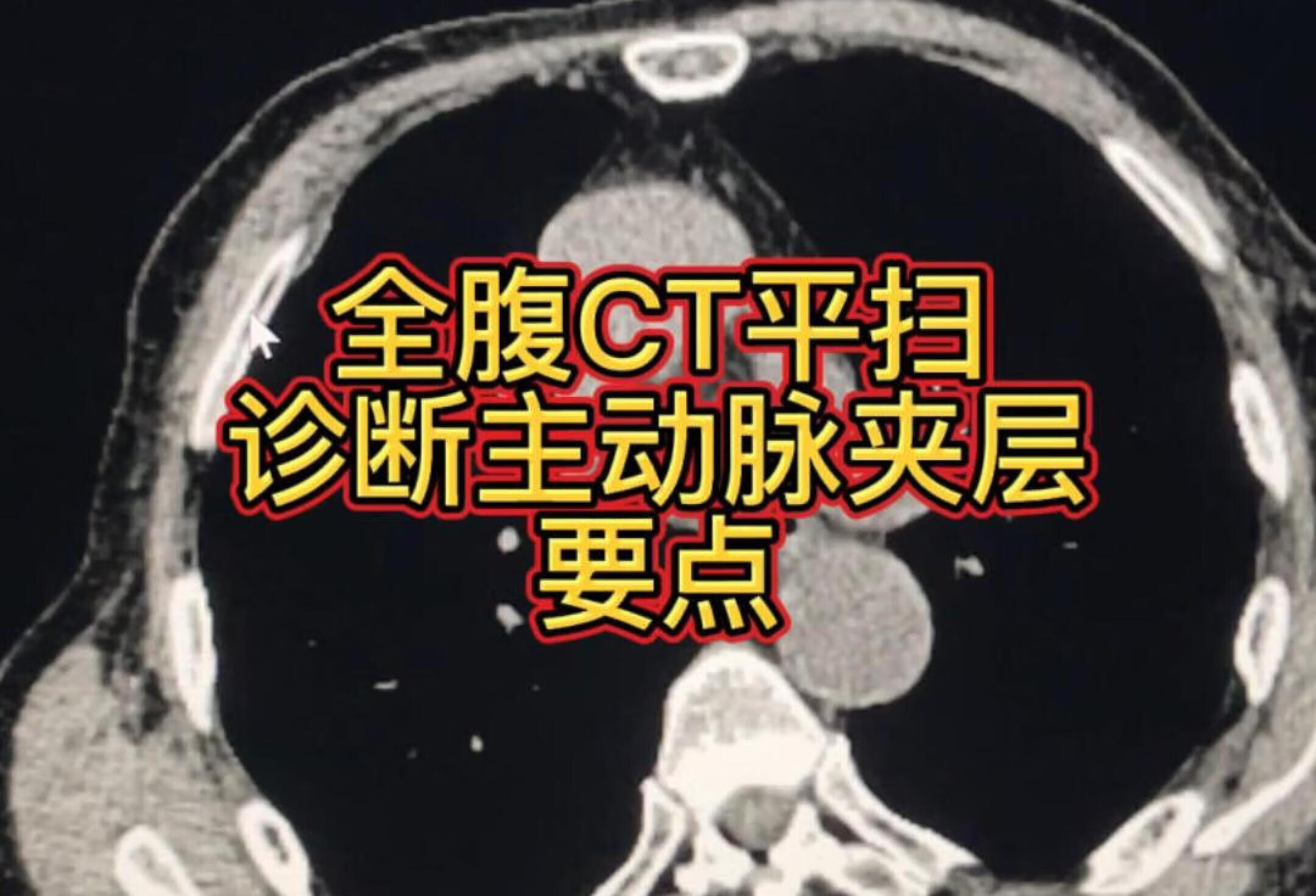 全腹CT平扫诊断主动脉夹层要点